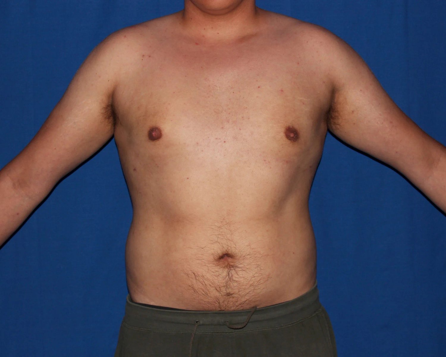 One-Stitch Gynecomastia after