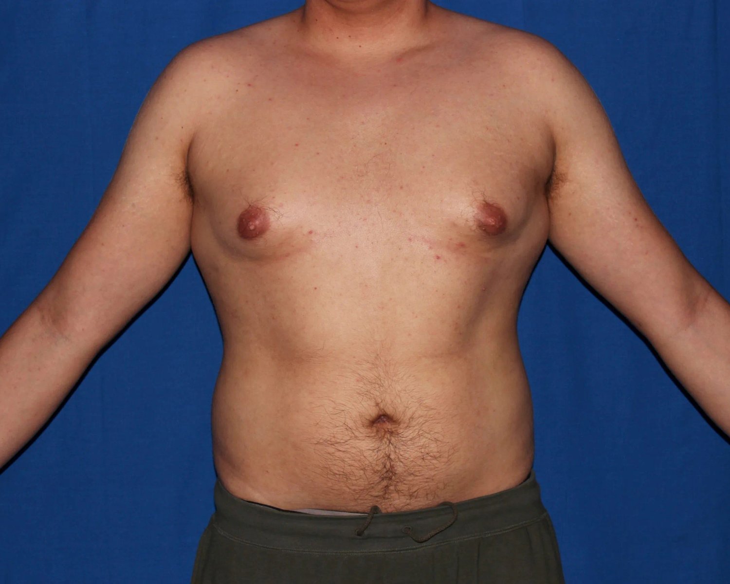 One-Stitch Gynecomastia before