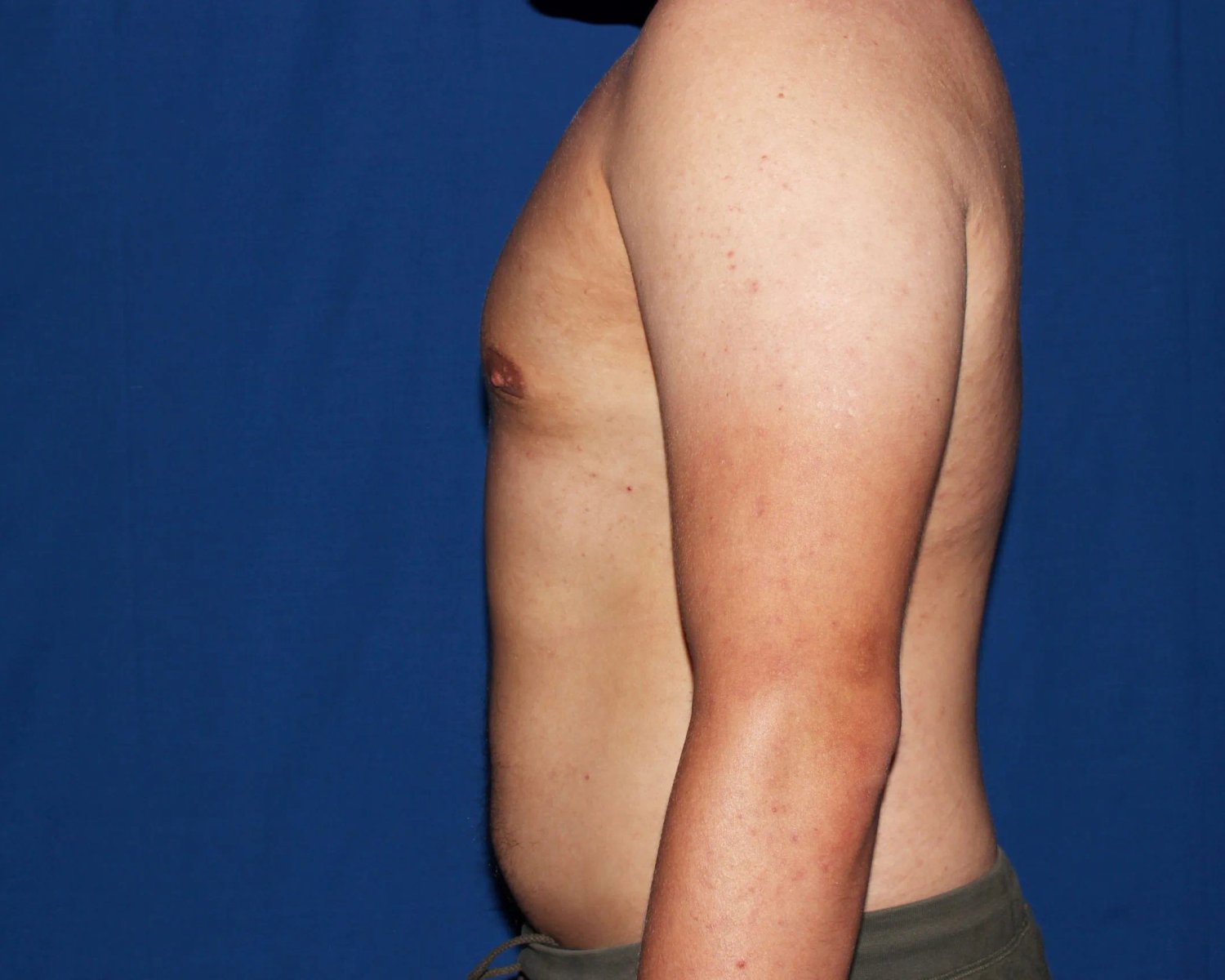One-Stitch Gynecomastia — Oblique Left view, after