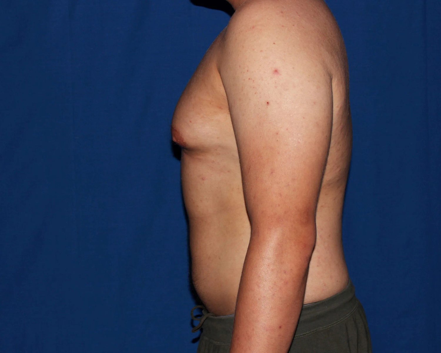 One-Stitch Gynecomastia — Oblique Left view, before