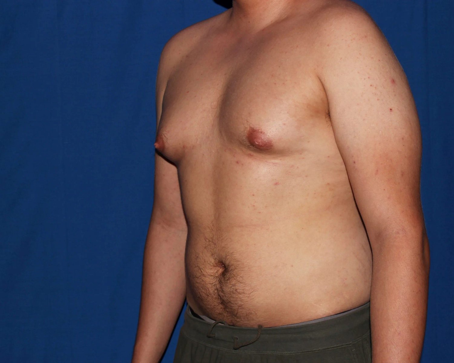 One-Stitch Gynecomastia — Oblique Right view, before