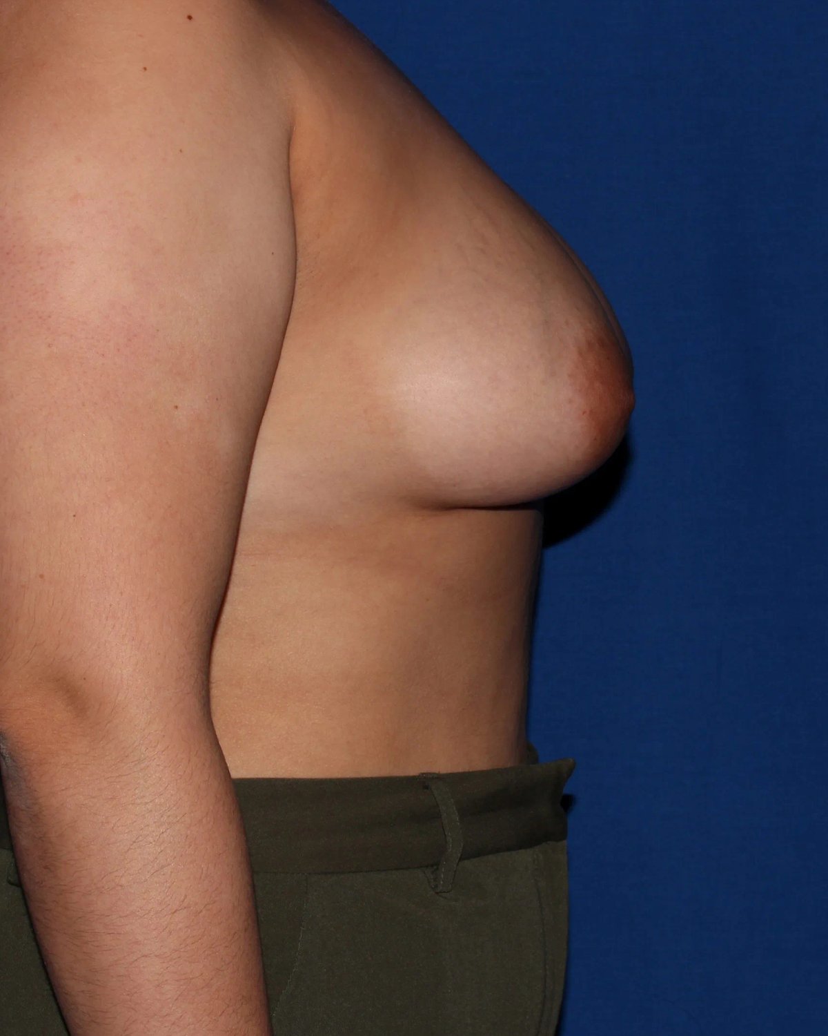 Breast Augmentation with Implants before