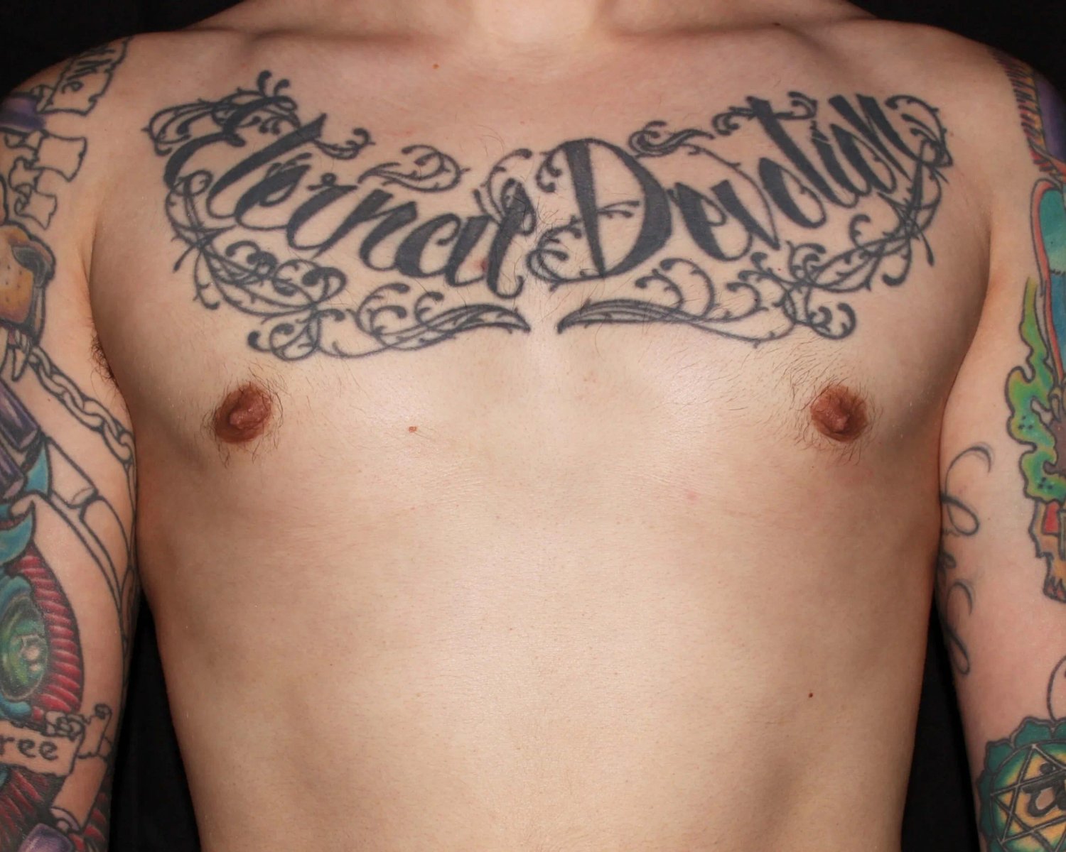 One-Stitch Gynecomastia after