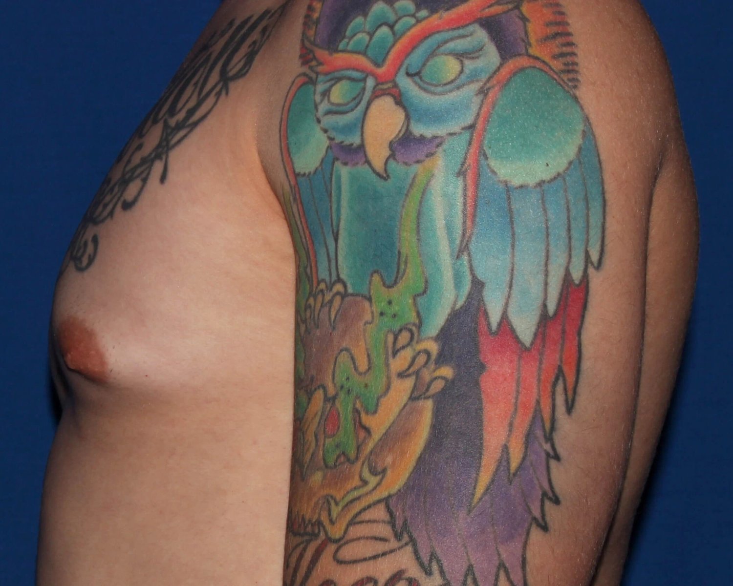 One-Stitch Gynecomastia — Oblique Left view, before