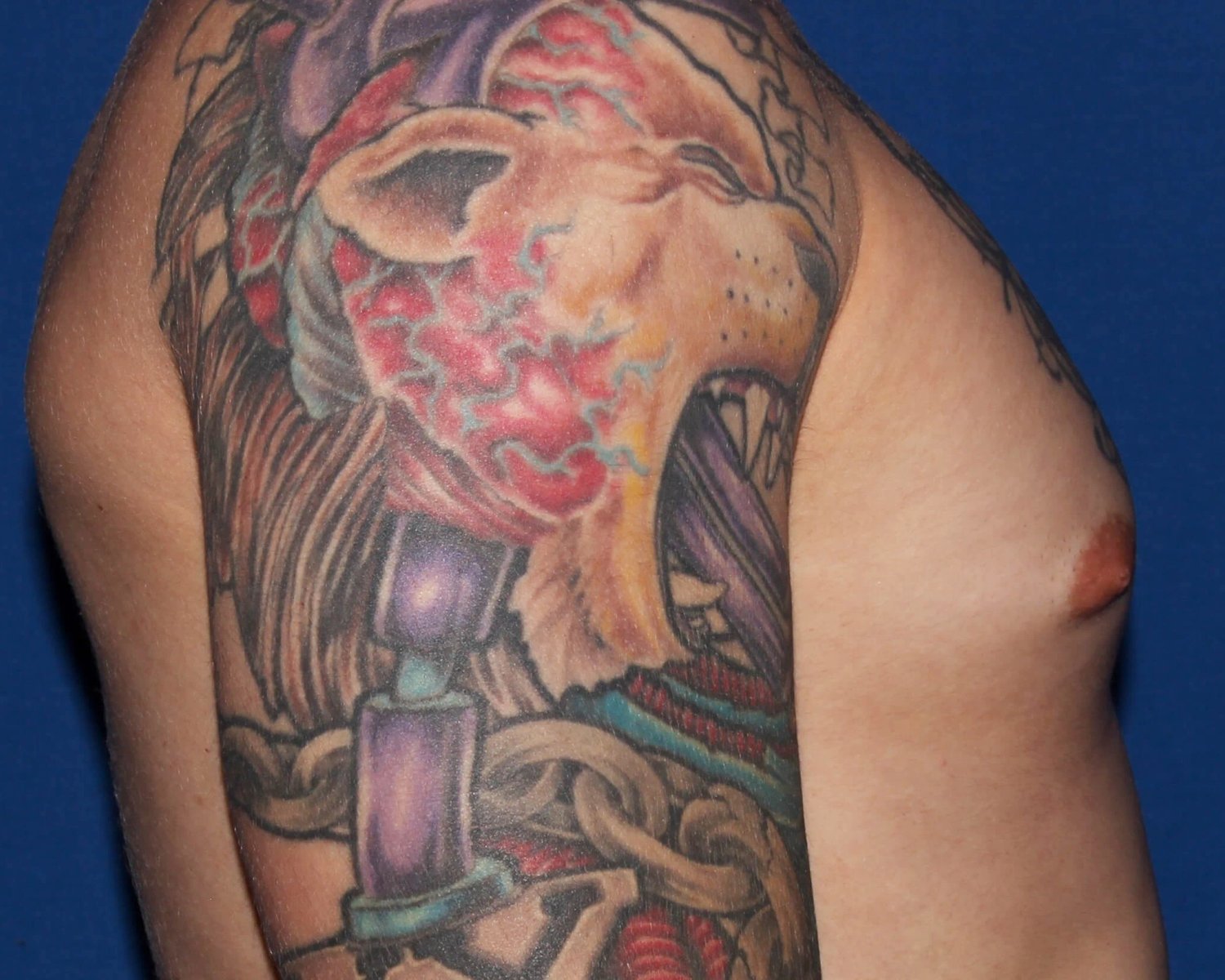 One-Stitch Gynecomastia — Oblique Right view, before