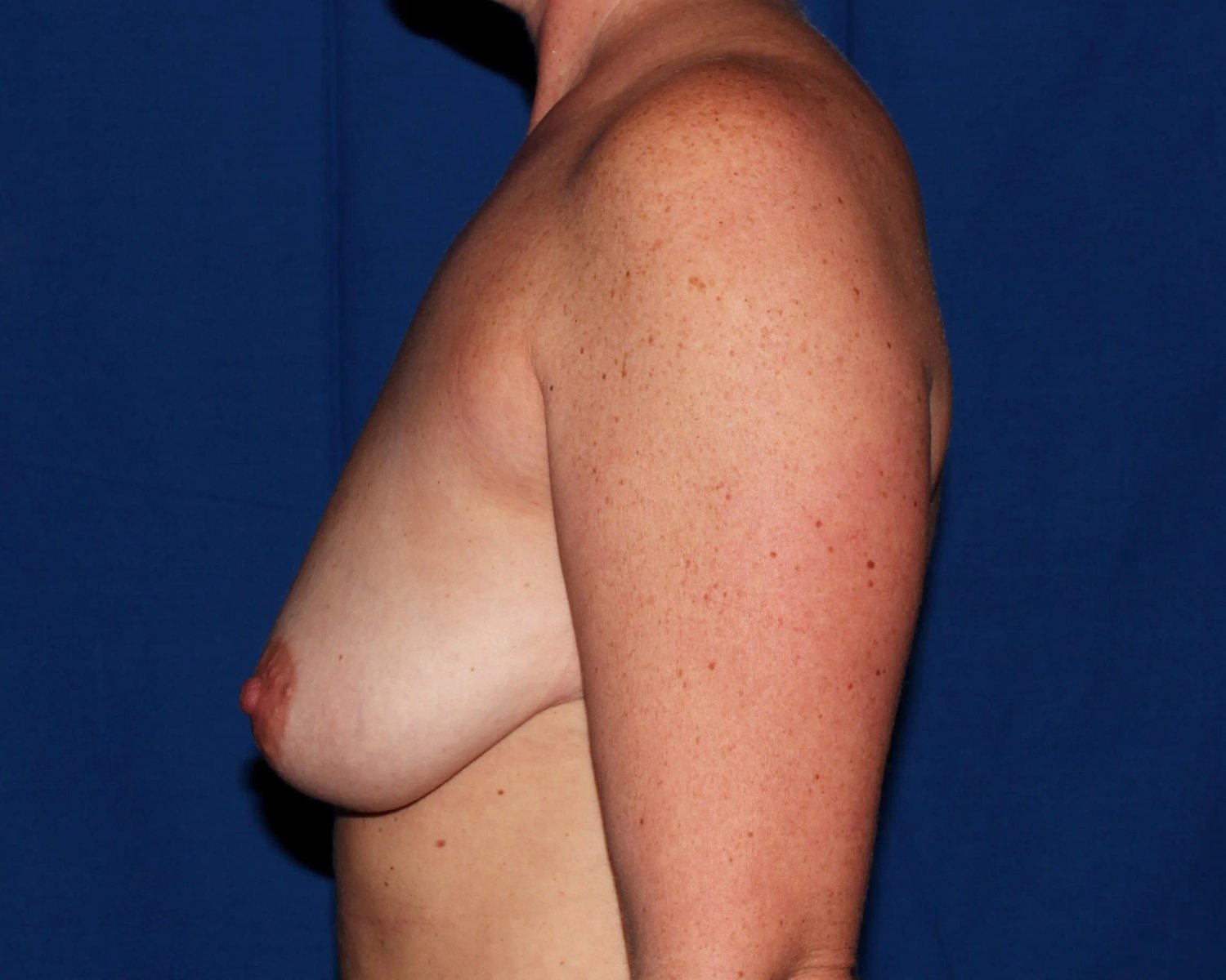 Breast Augmentation with Implants before