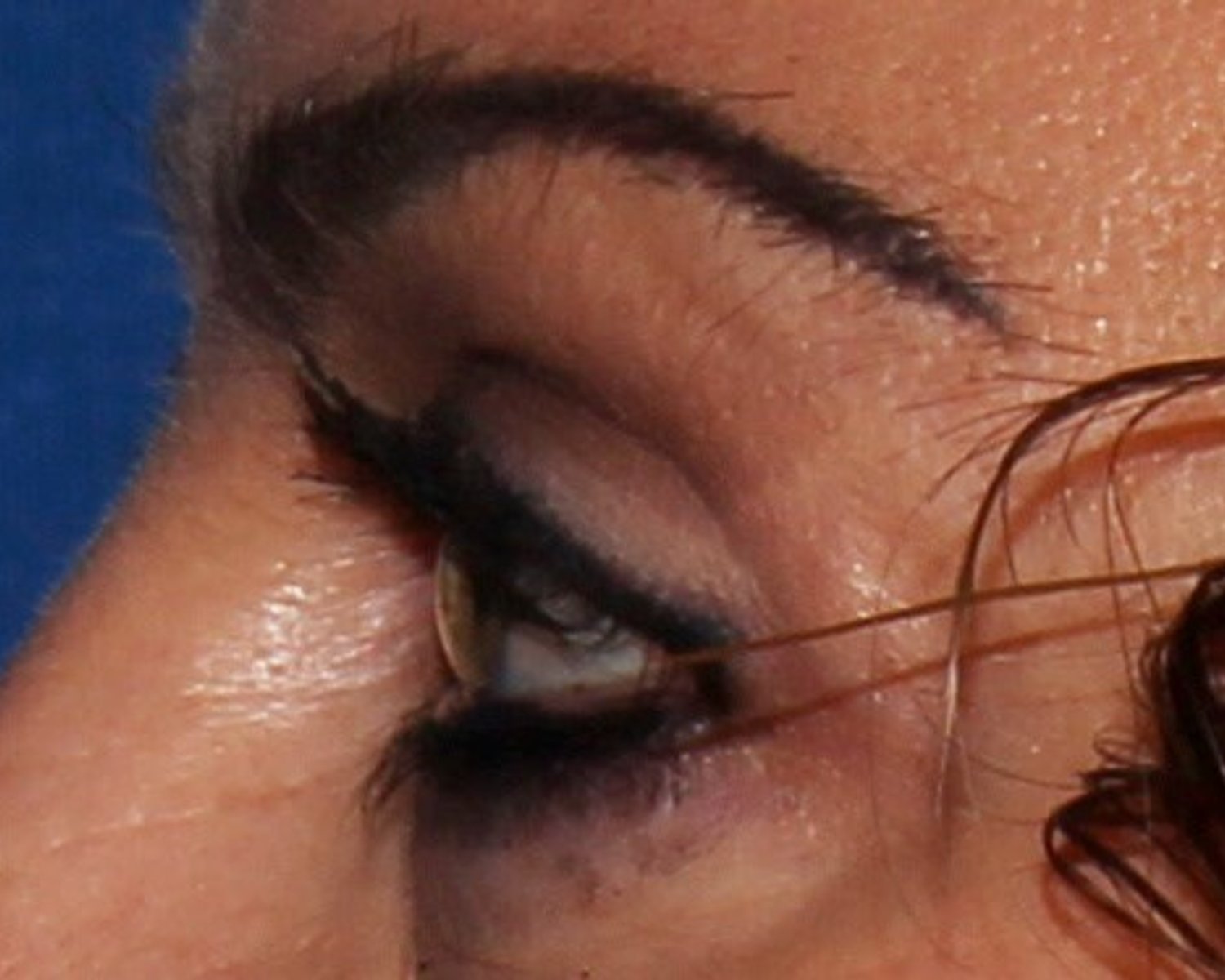 Eyelid Surgery — Oblique Left view, after