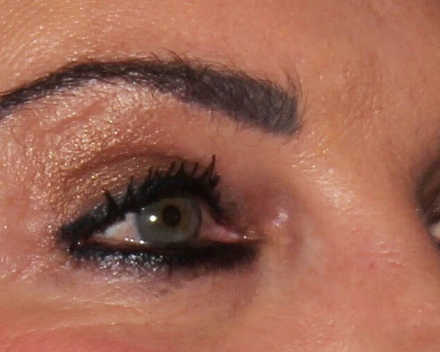 Eyelid Surgery after