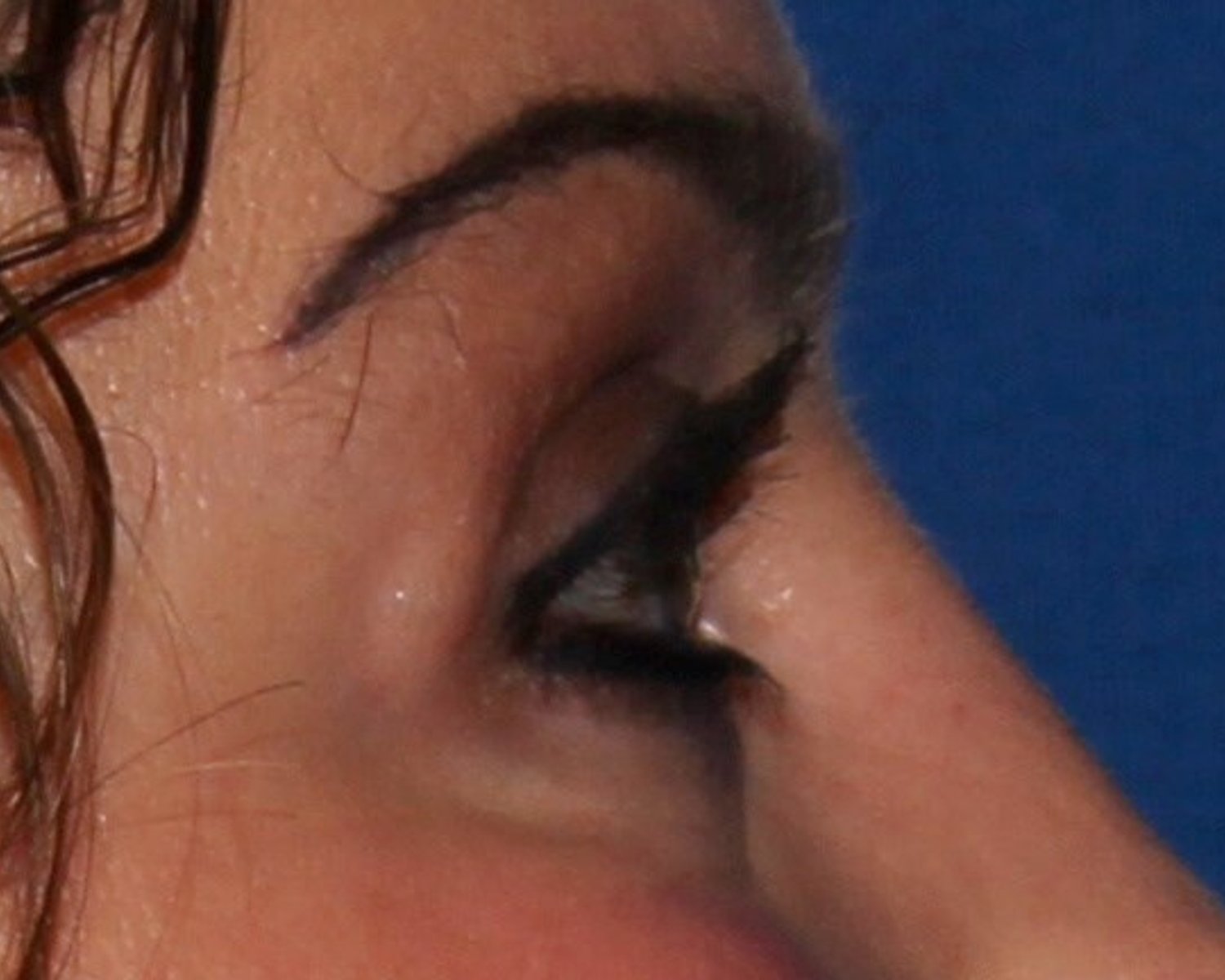 Eyelid Surgery — Oblique Right view, after