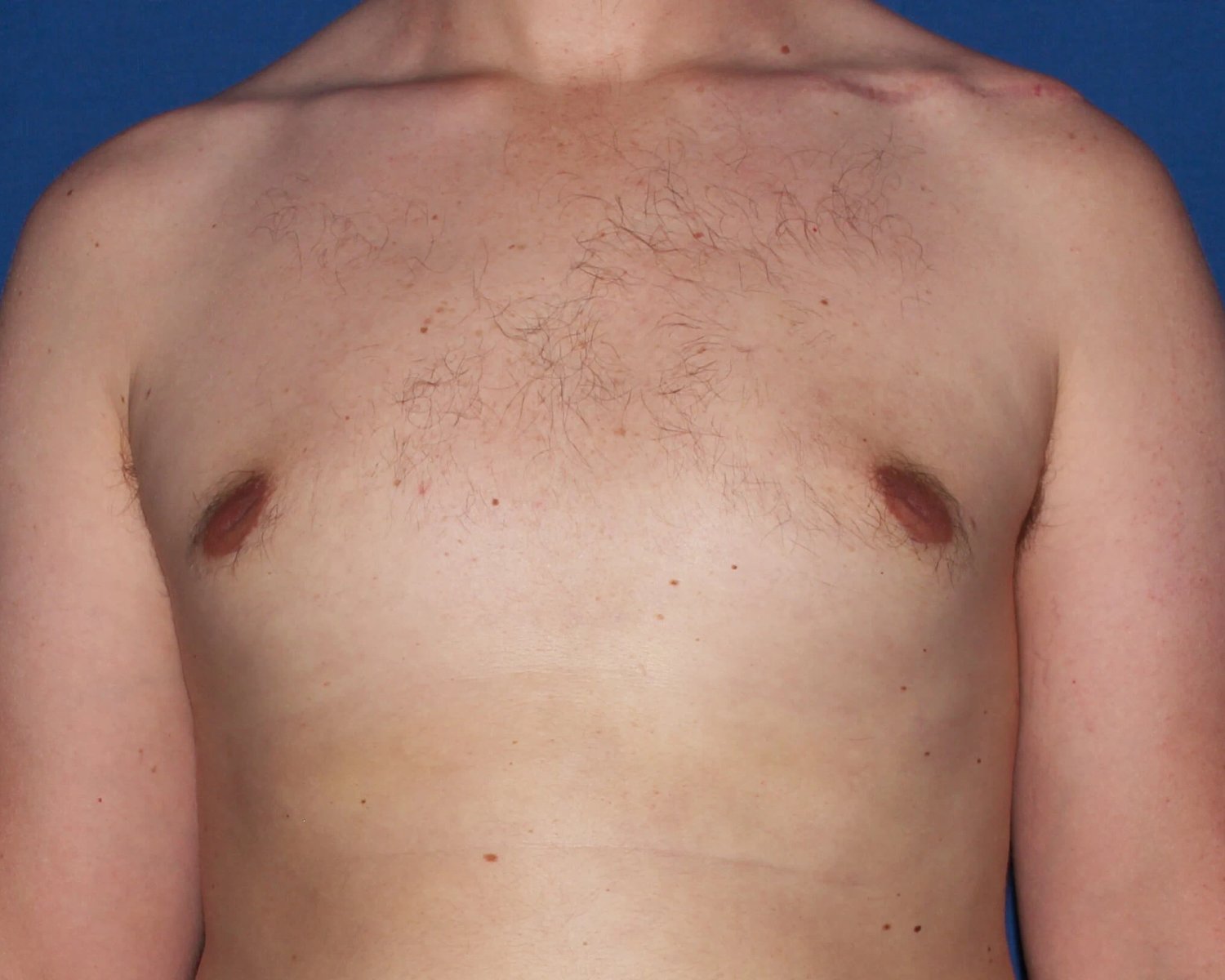 One-Stitch Gynecomastia after