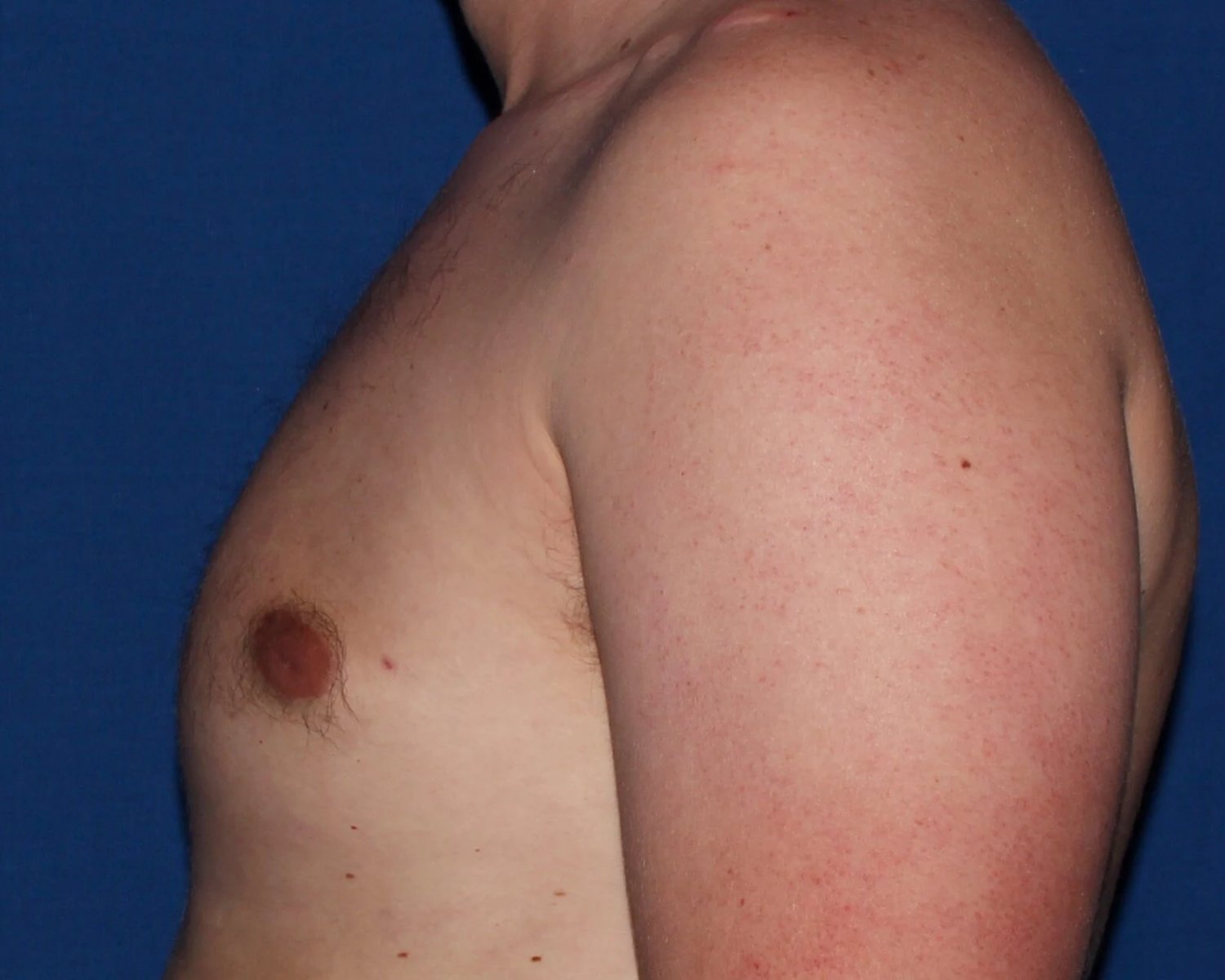 One-Stitch Gynecomastia — Oblique Left view, after
