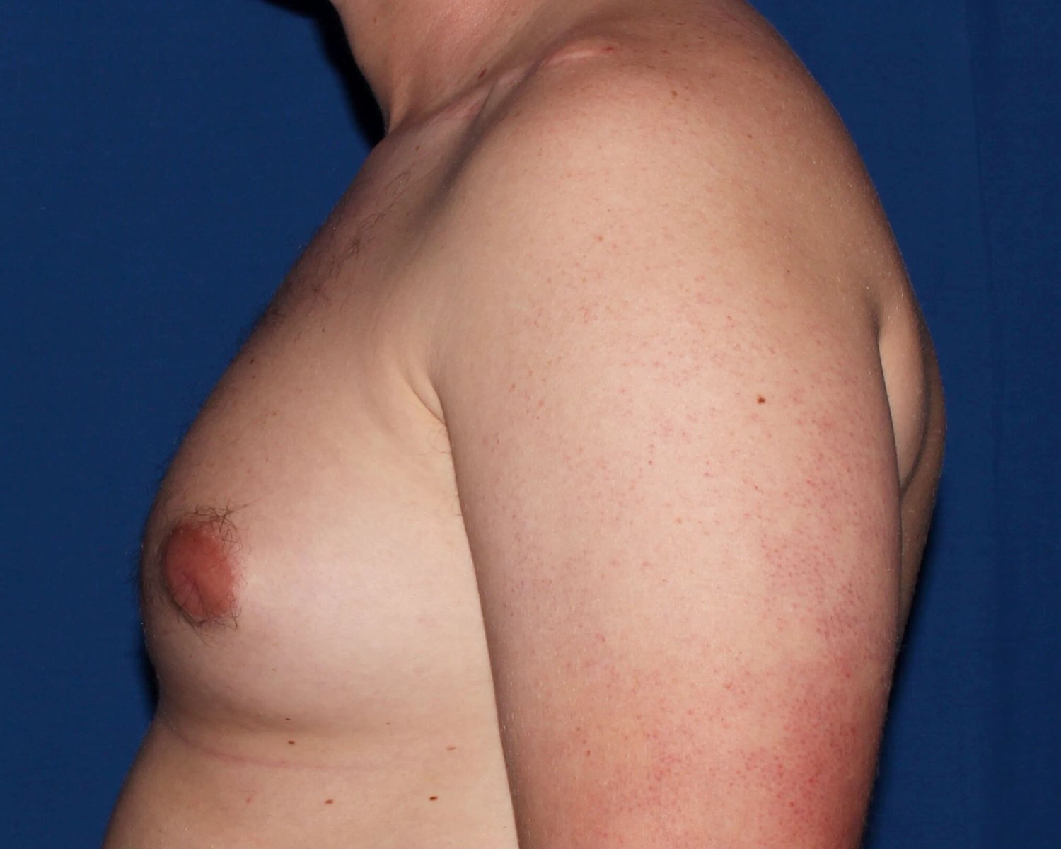 One-Stitch Gynecomastia — Oblique Left view, before