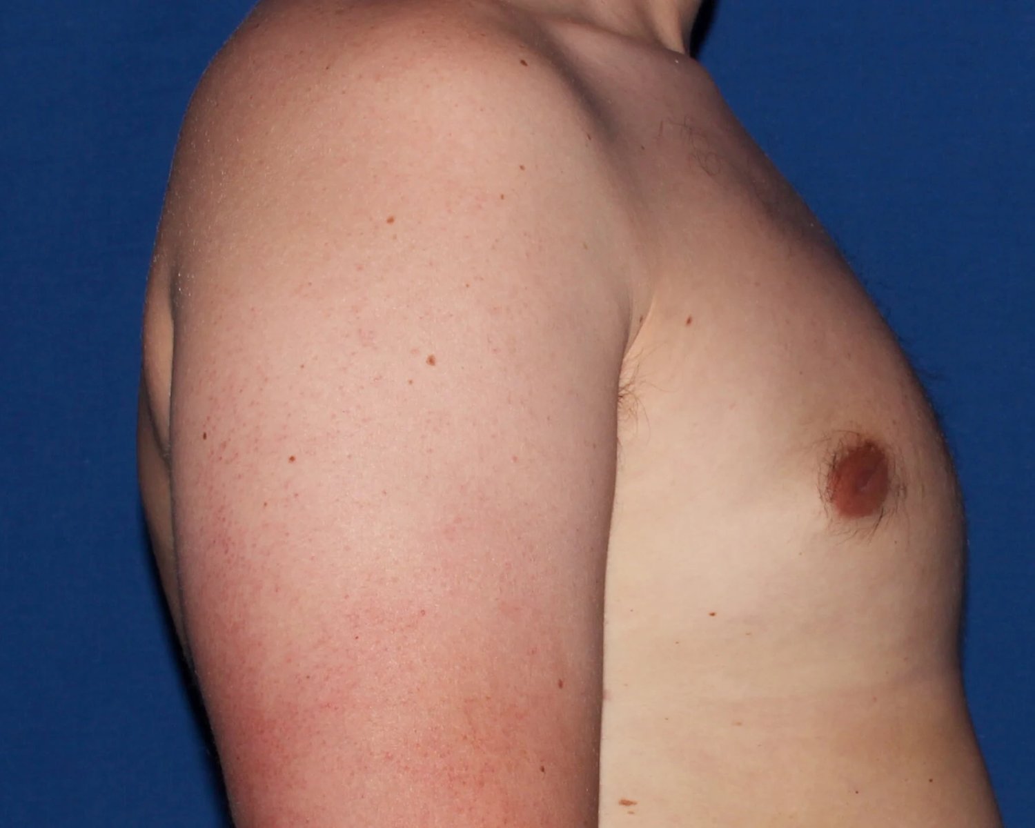 One-Stitch Gynecomastia — Oblique Right view, after