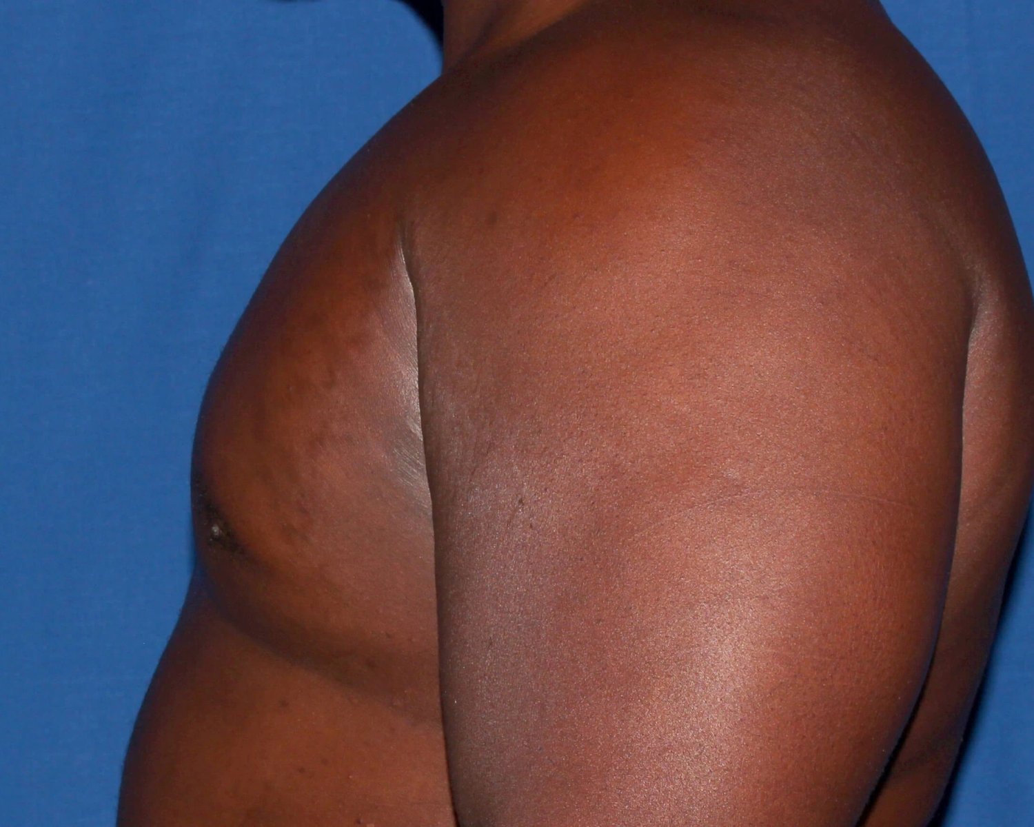 One-Stitch Gynecomastia — Oblique Left view, after