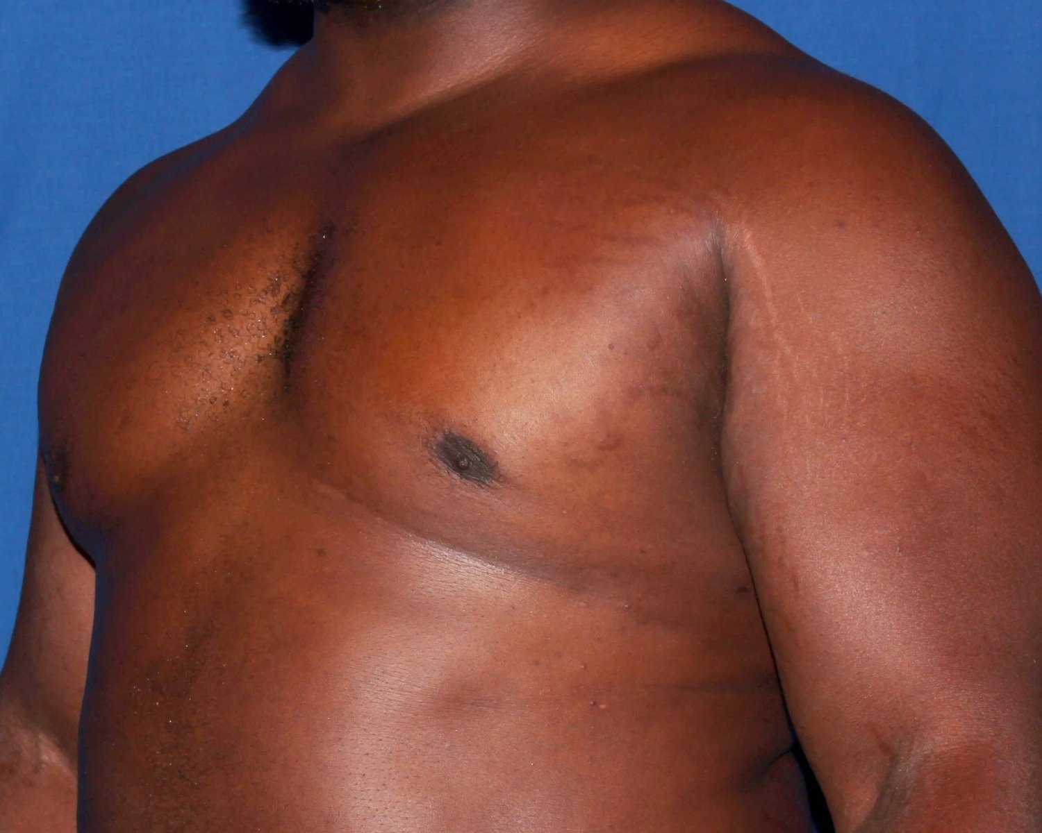 One-Stitch Gynecomastia after