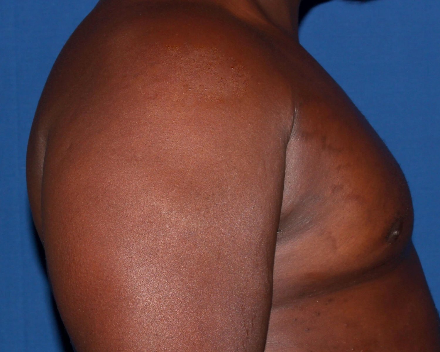 One-Stitch Gynecomastia — Oblique Right view, after