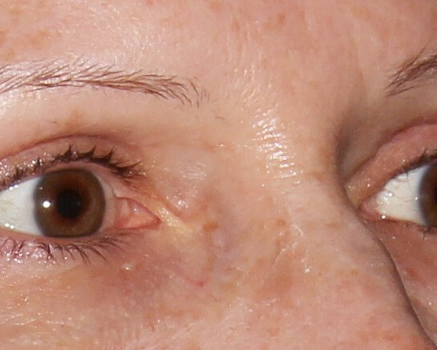 Eyelid Surgery — Oblique Right view, after