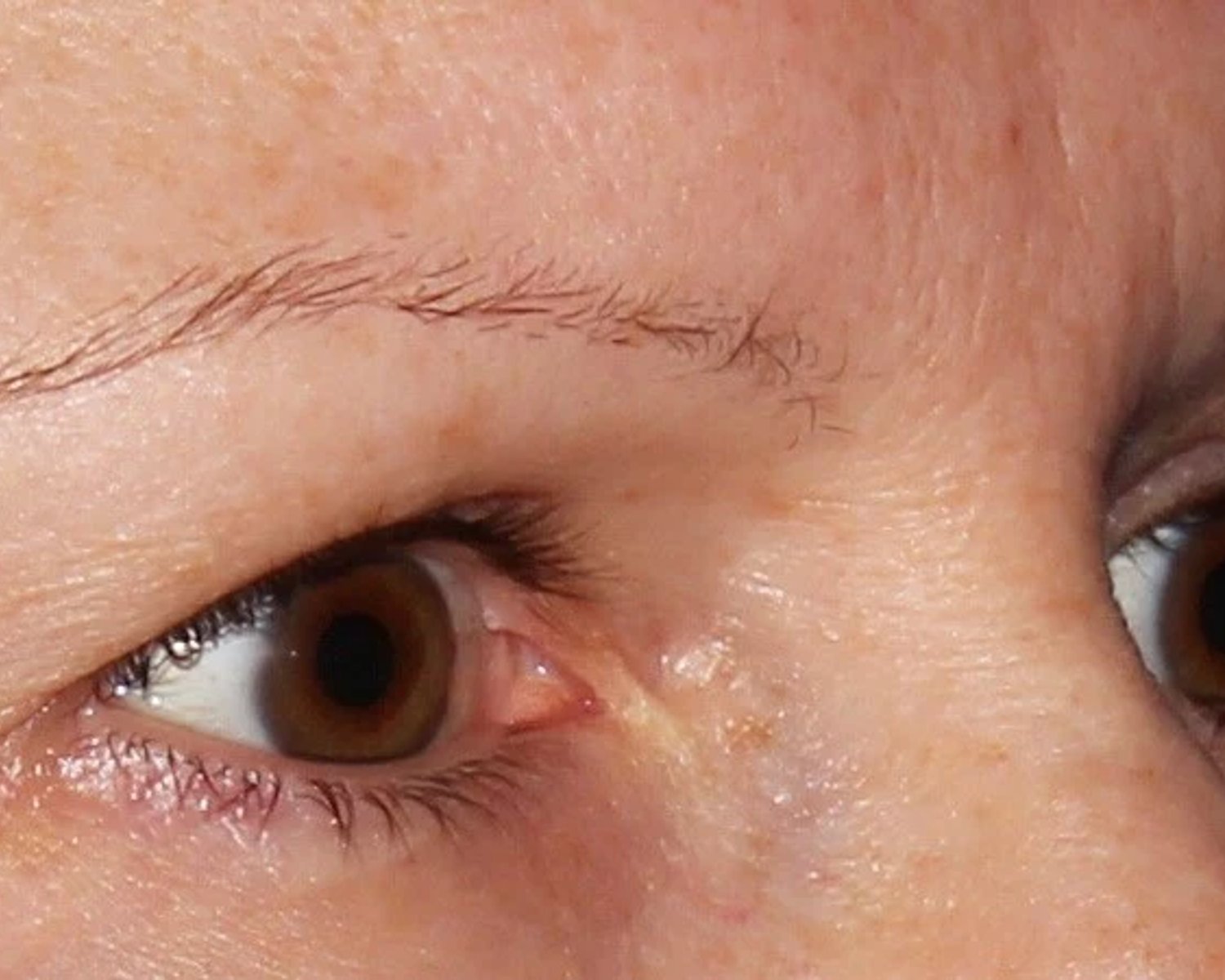 Eyelid Surgery — Oblique Right view, before