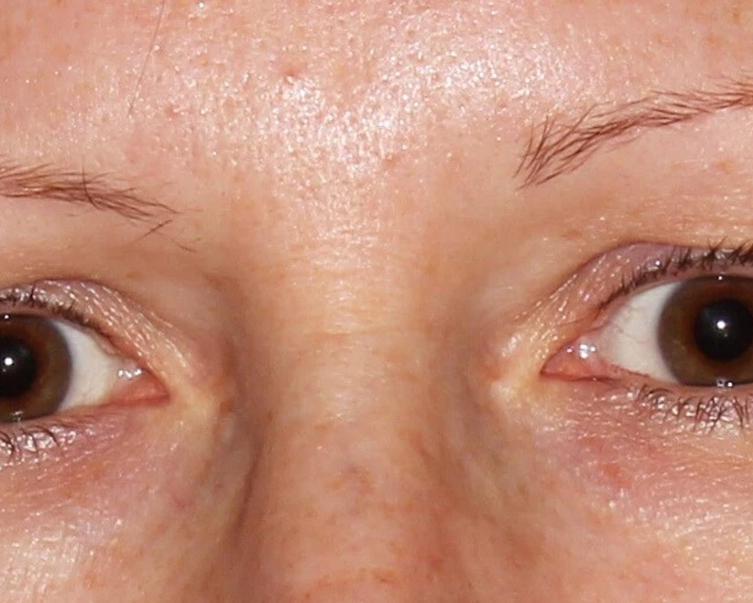 Eyelid Surgery before