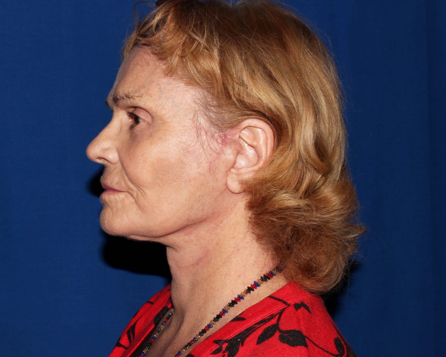 Facelift (neck lift included) — Oblique Left view, after