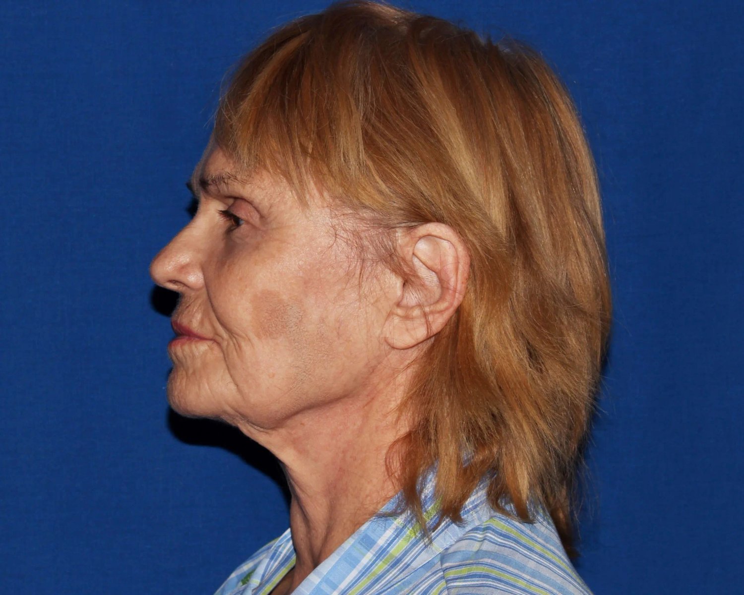 Facelift (neck lift included) — Oblique Left view, before