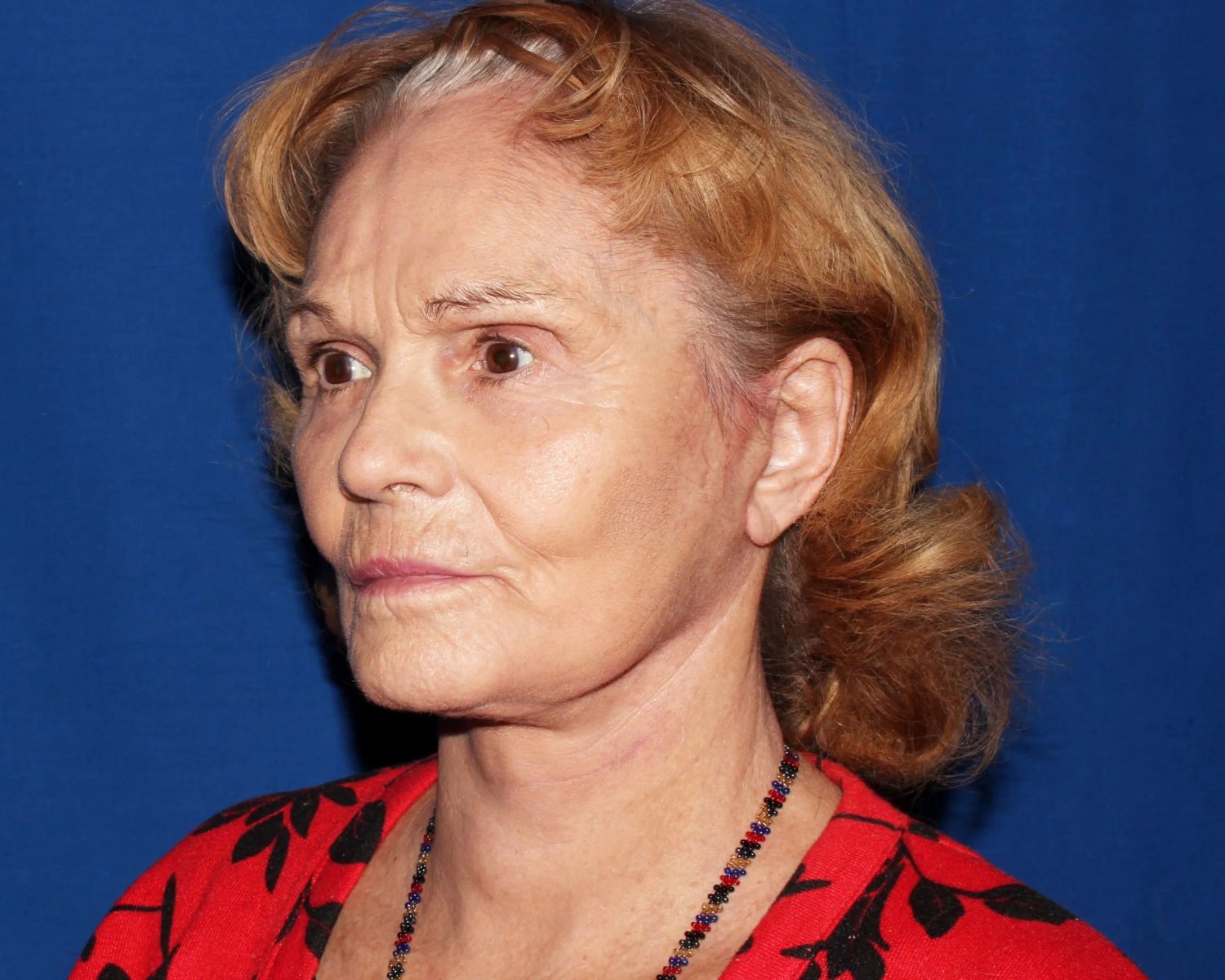 Facelift (neck lift included) — Oblique Right view, after