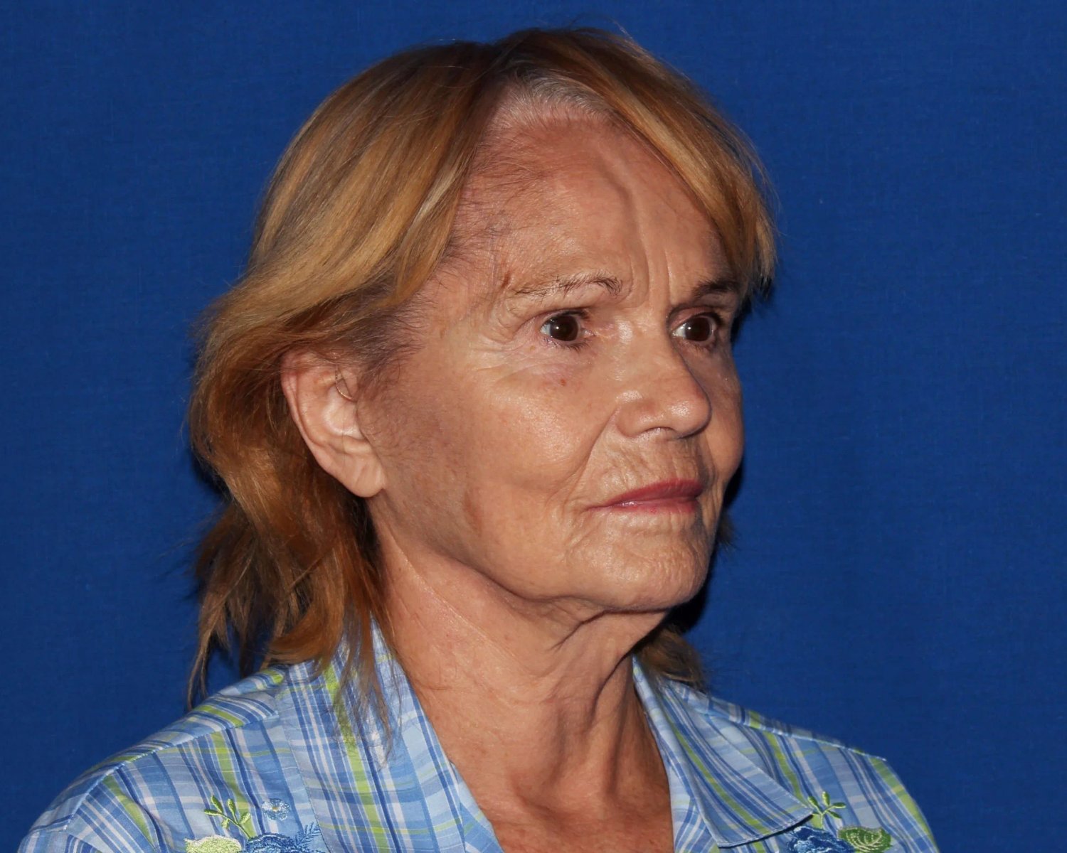 Facelift (neck lift included) before
