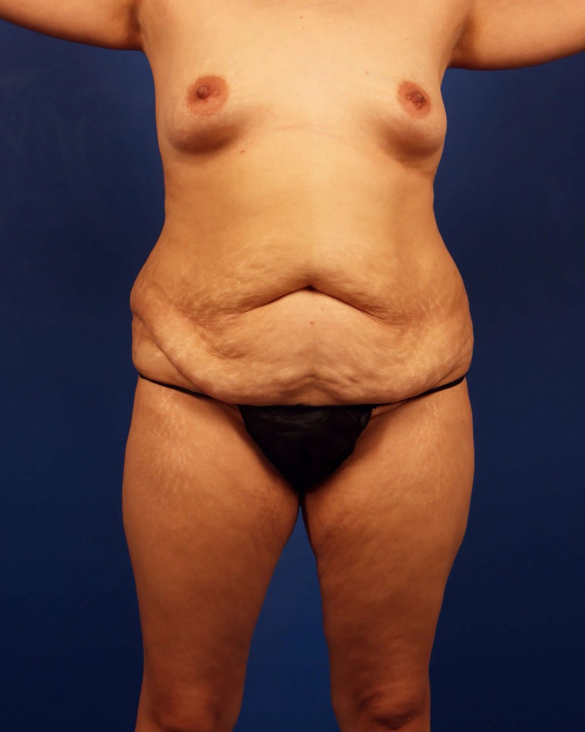 Tummy Tuck before