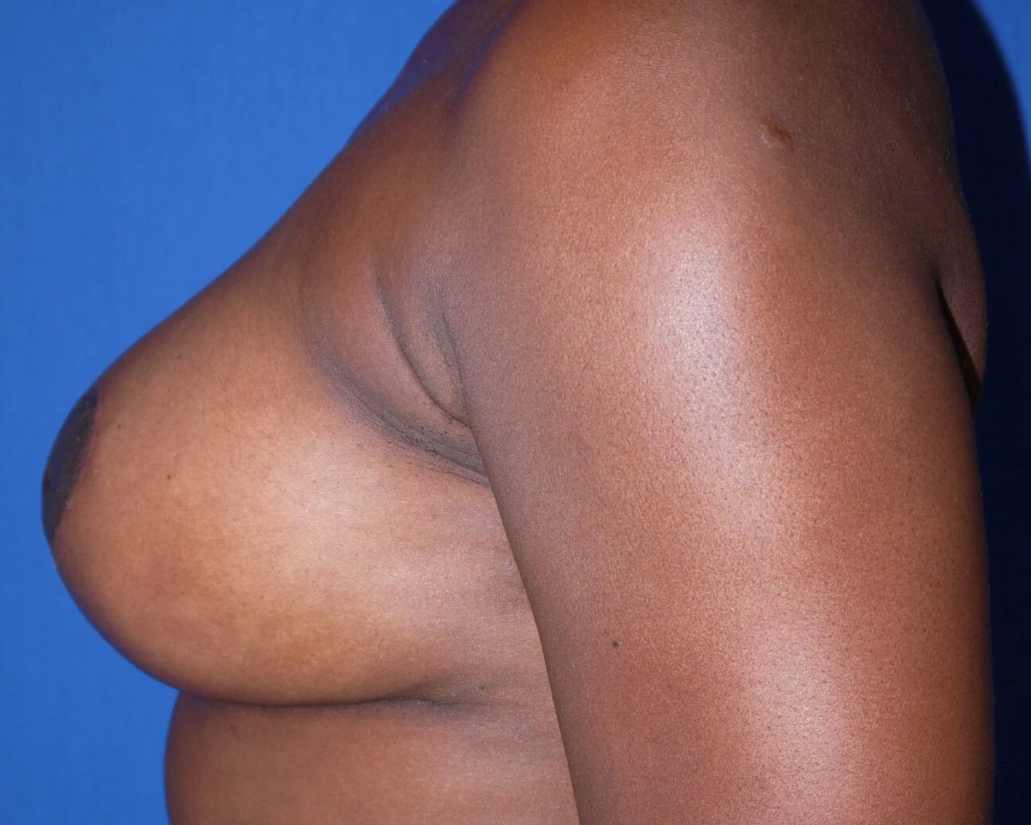Breast Augmentation with Implants — Oblique Left view, after