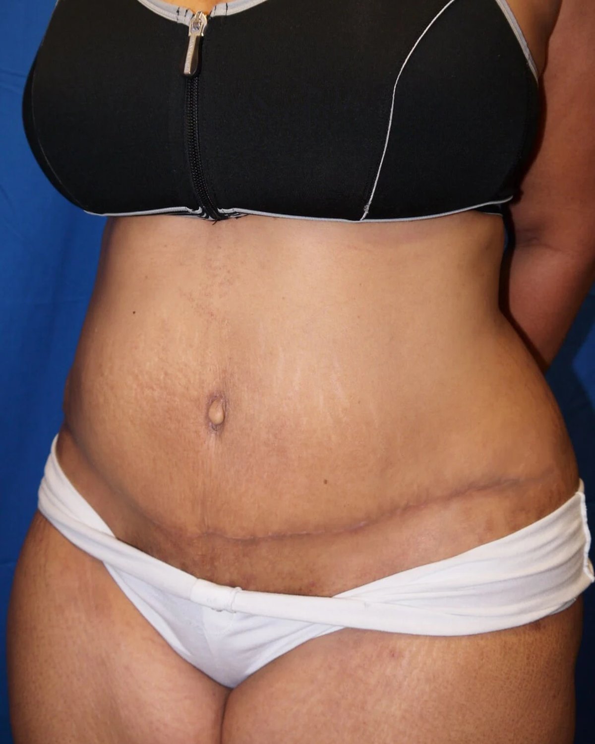 Tummy Tuck after