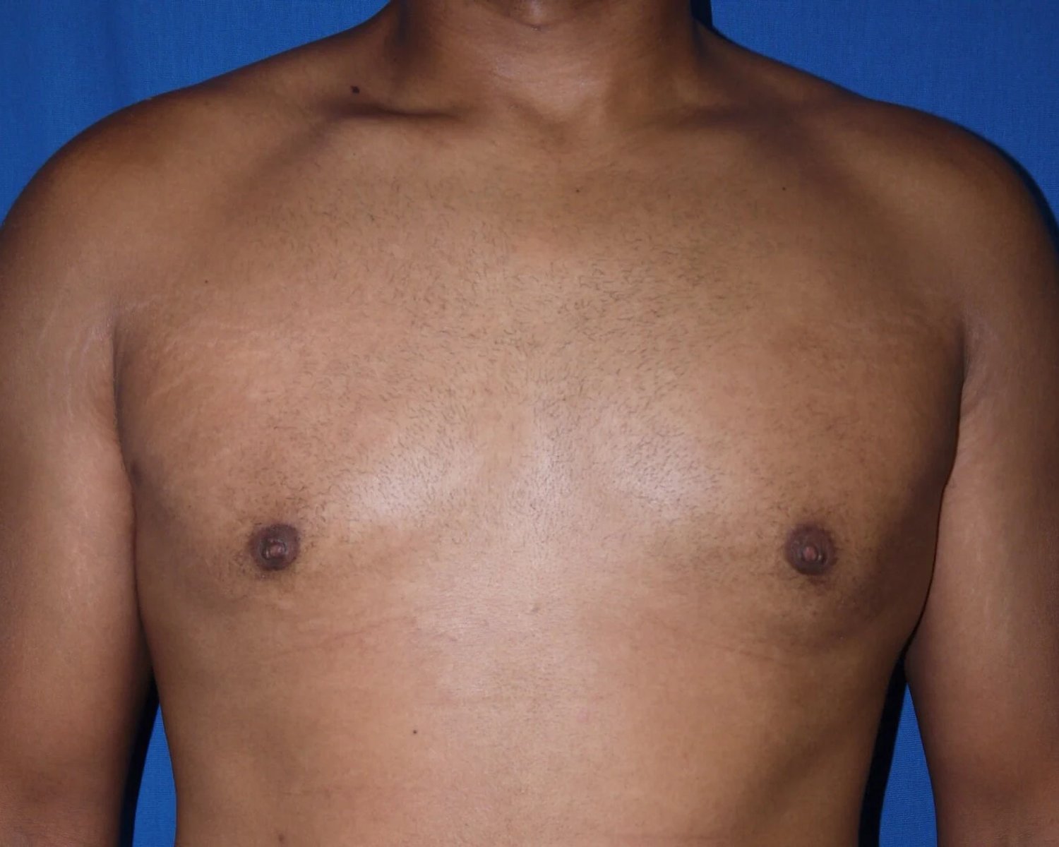 One-Stitch Gynecomastia after