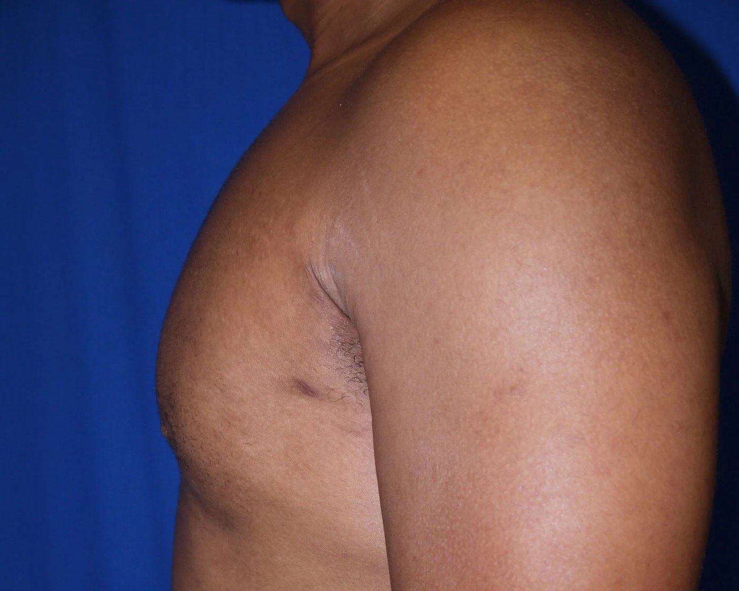 One-Stitch Gynecomastia — Oblique Left view, after