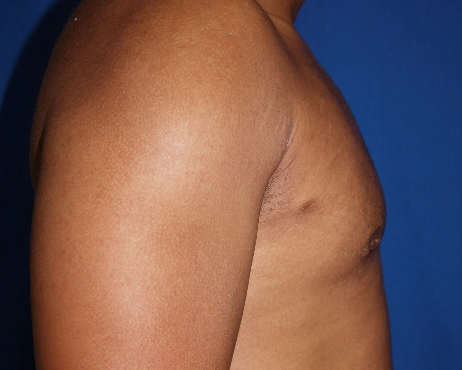 One-Stitch Gynecomastia — Oblique Right view, after