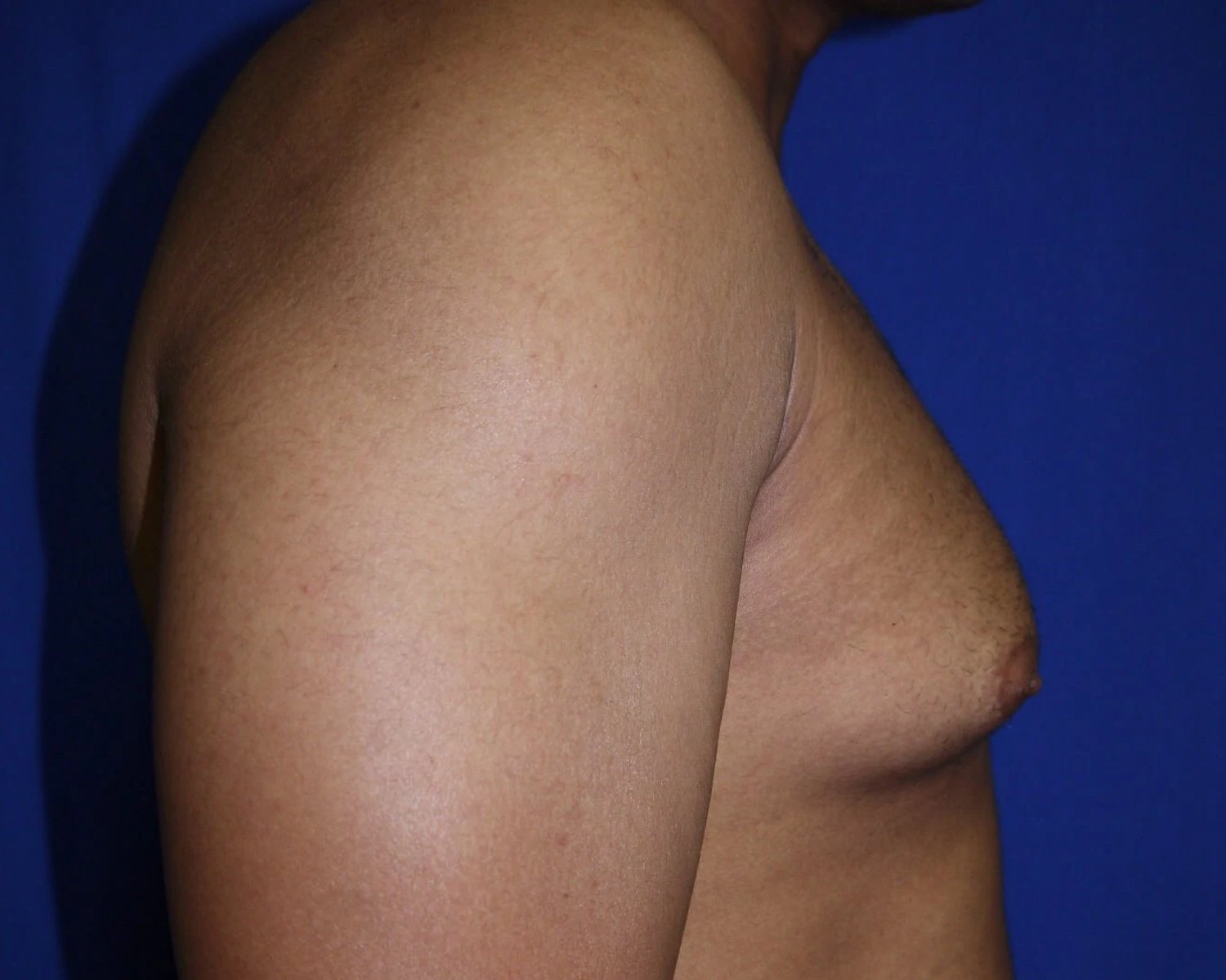 One-Stitch Gynecomastia — Oblique Right view, before