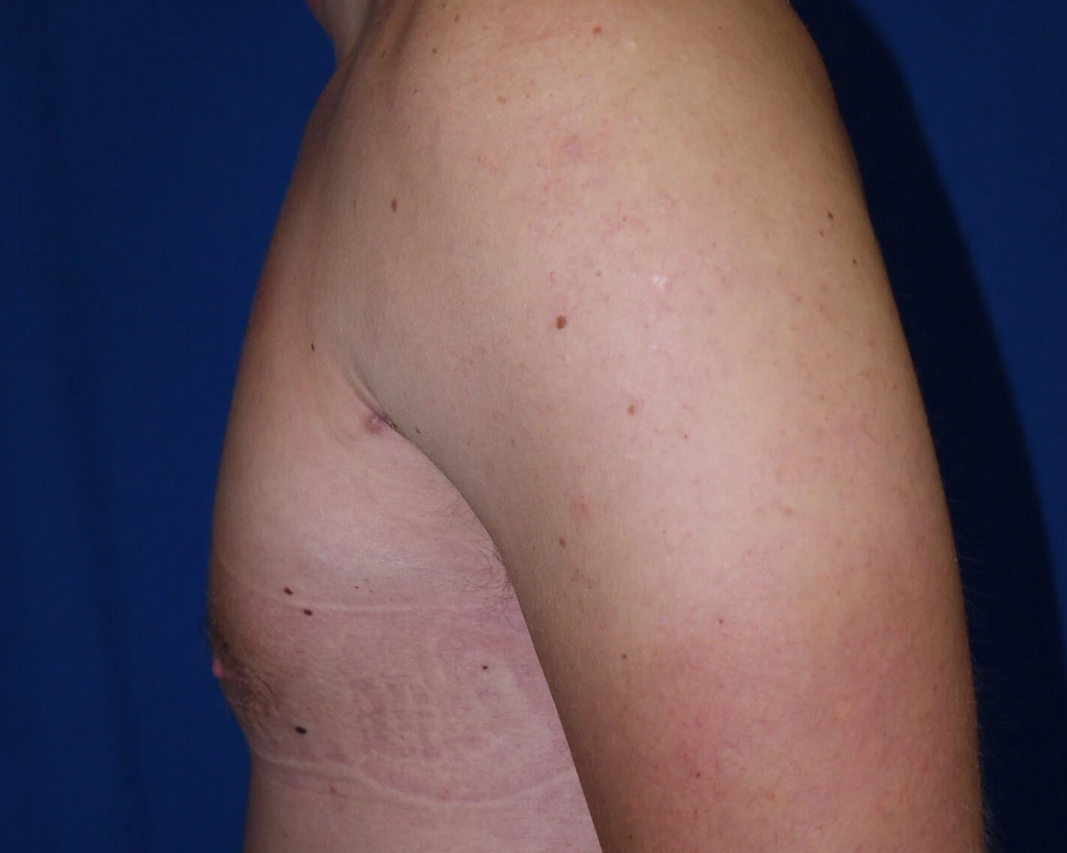 One-Stitch Gynecomastia — Oblique Left view, after