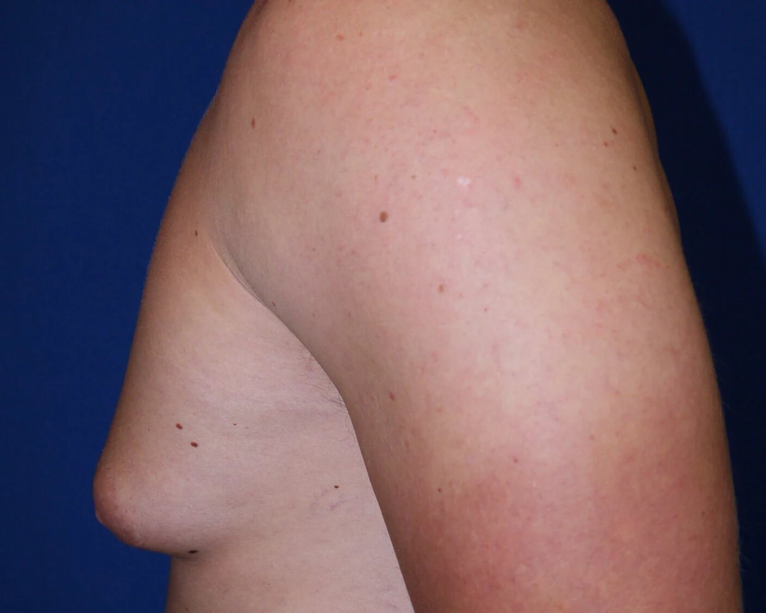 One-Stitch Gynecomastia — Oblique Left view, before