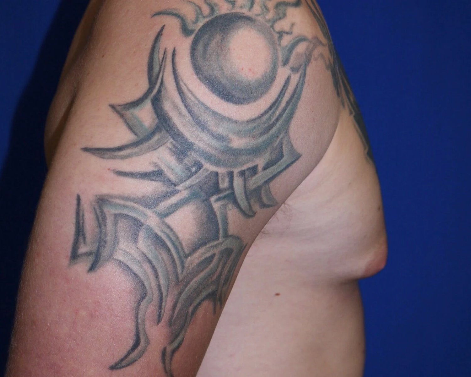 One-Stitch Gynecomastia — Oblique Right view, before