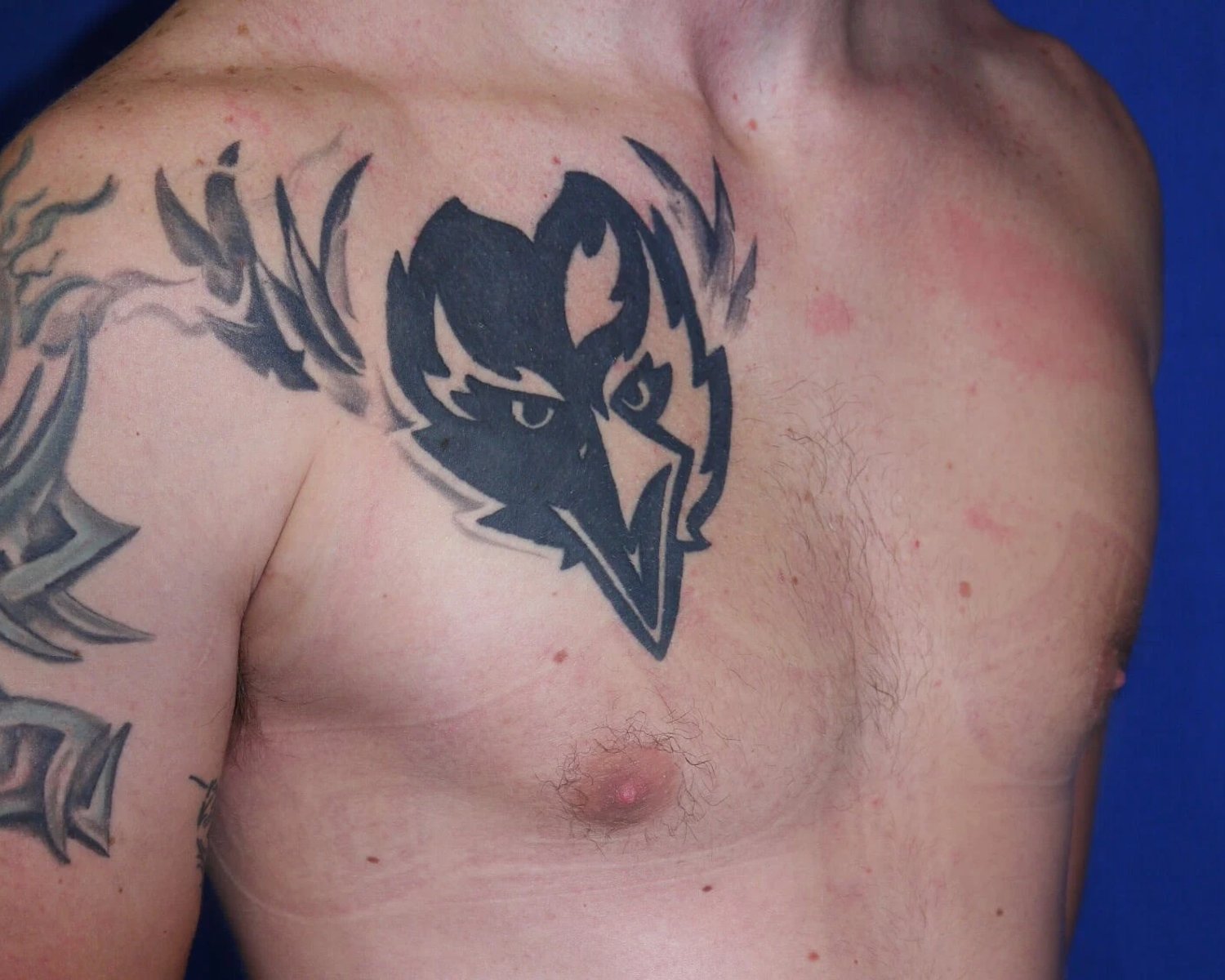 One-Stitch Gynecomastia after