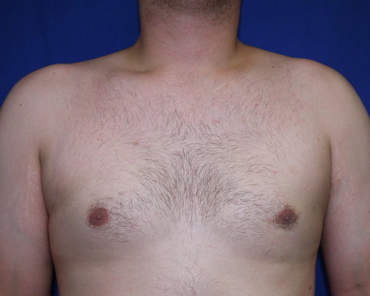 One-Stitch Gynecomastia after