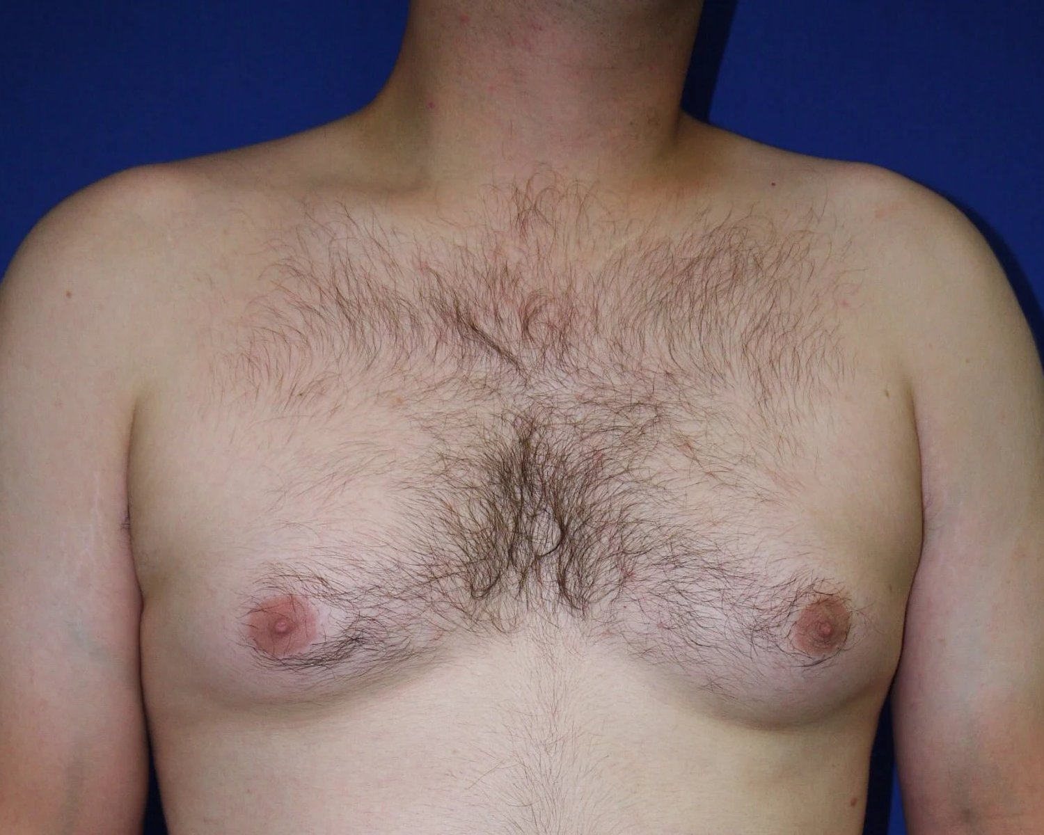 One-Stitch Gynecomastia before