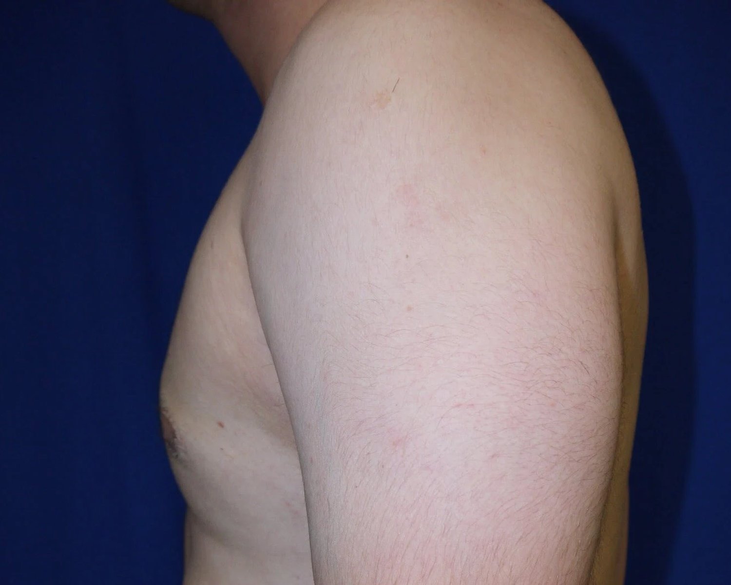 One-Stitch Gynecomastia — Oblique Left view, after
