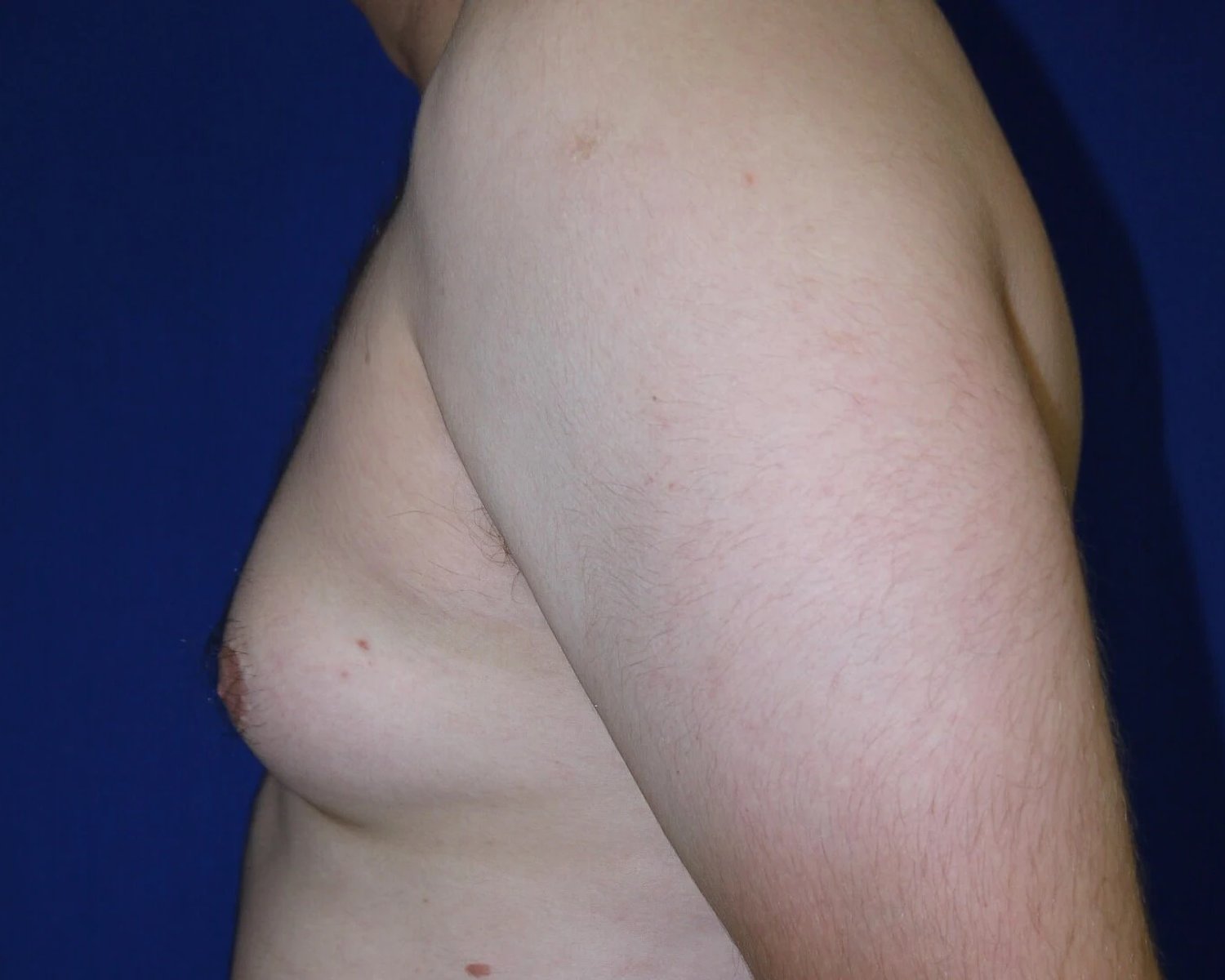 One-Stitch Gynecomastia — Oblique Left view, before