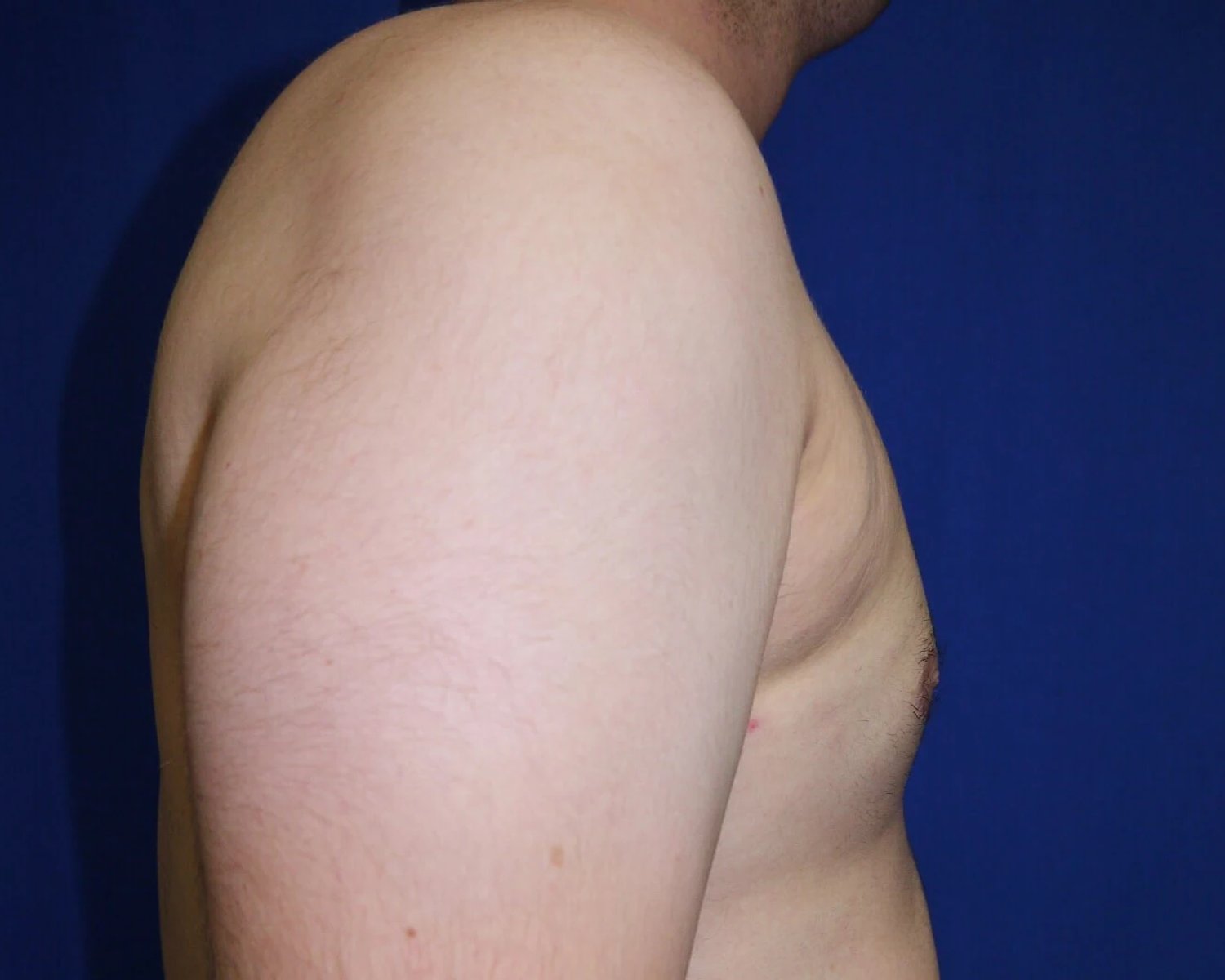 One-Stitch Gynecomastia — Oblique Right view, after
