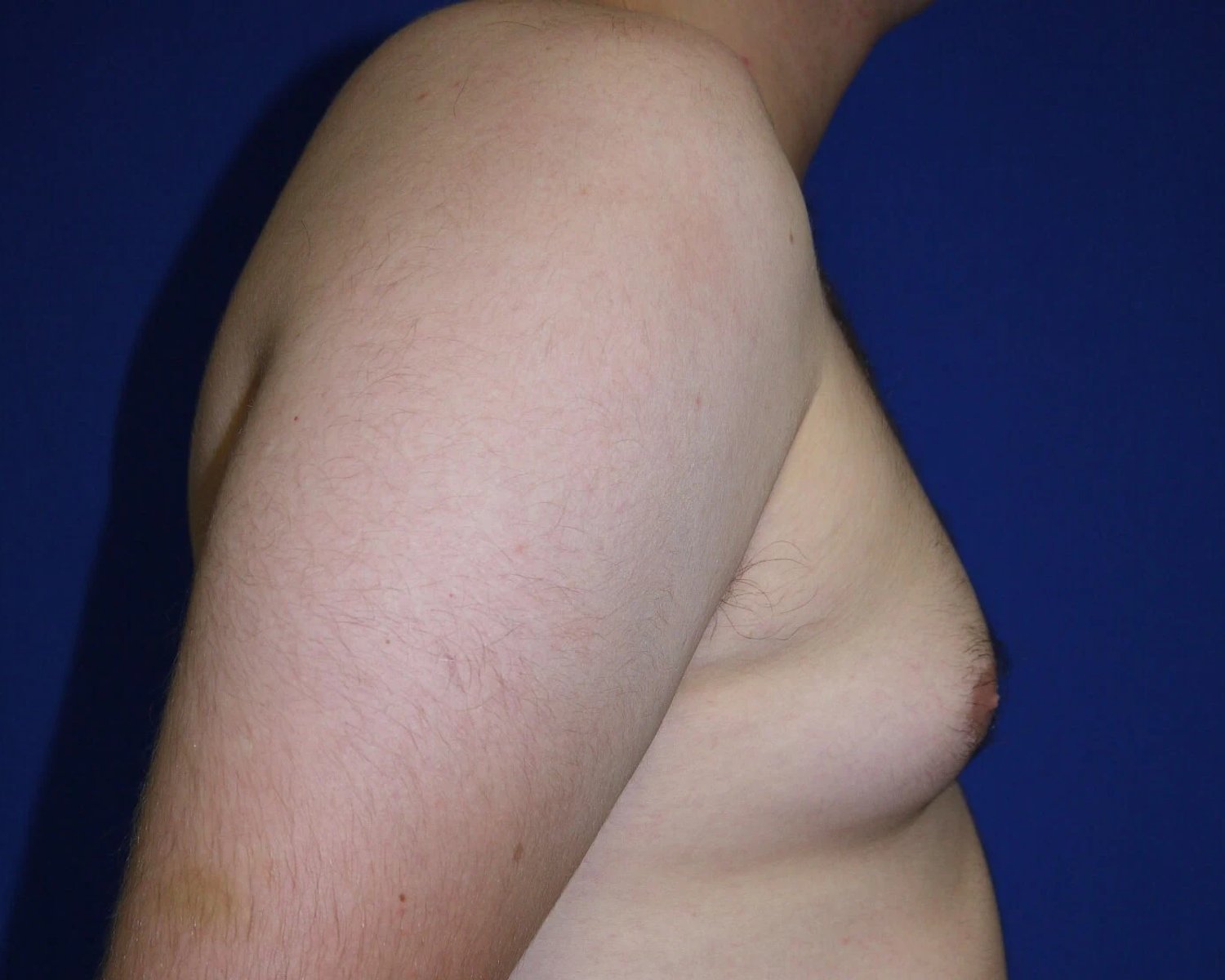 One-Stitch Gynecomastia — Oblique Right view, before