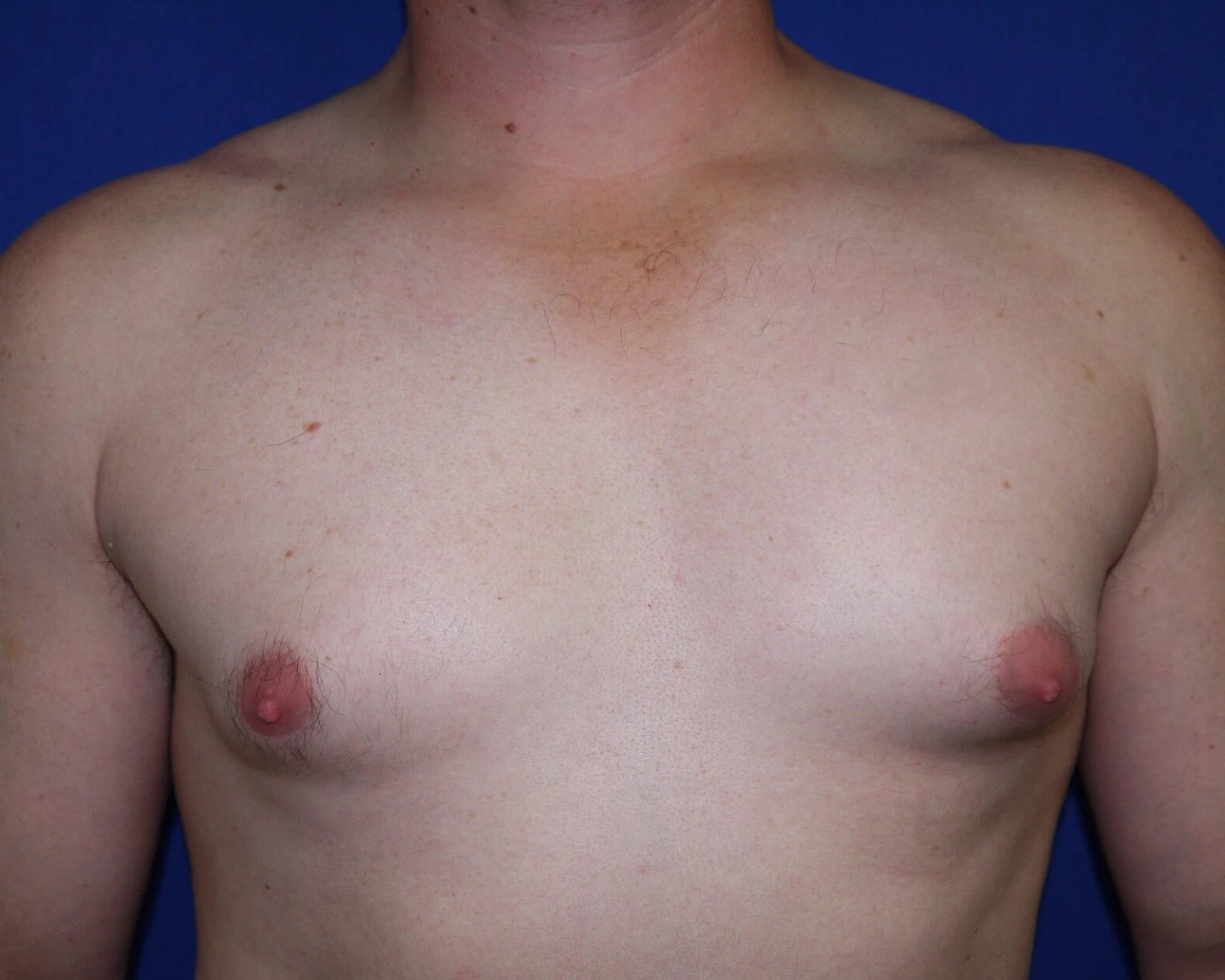 One-Stitch Gynecomastia before