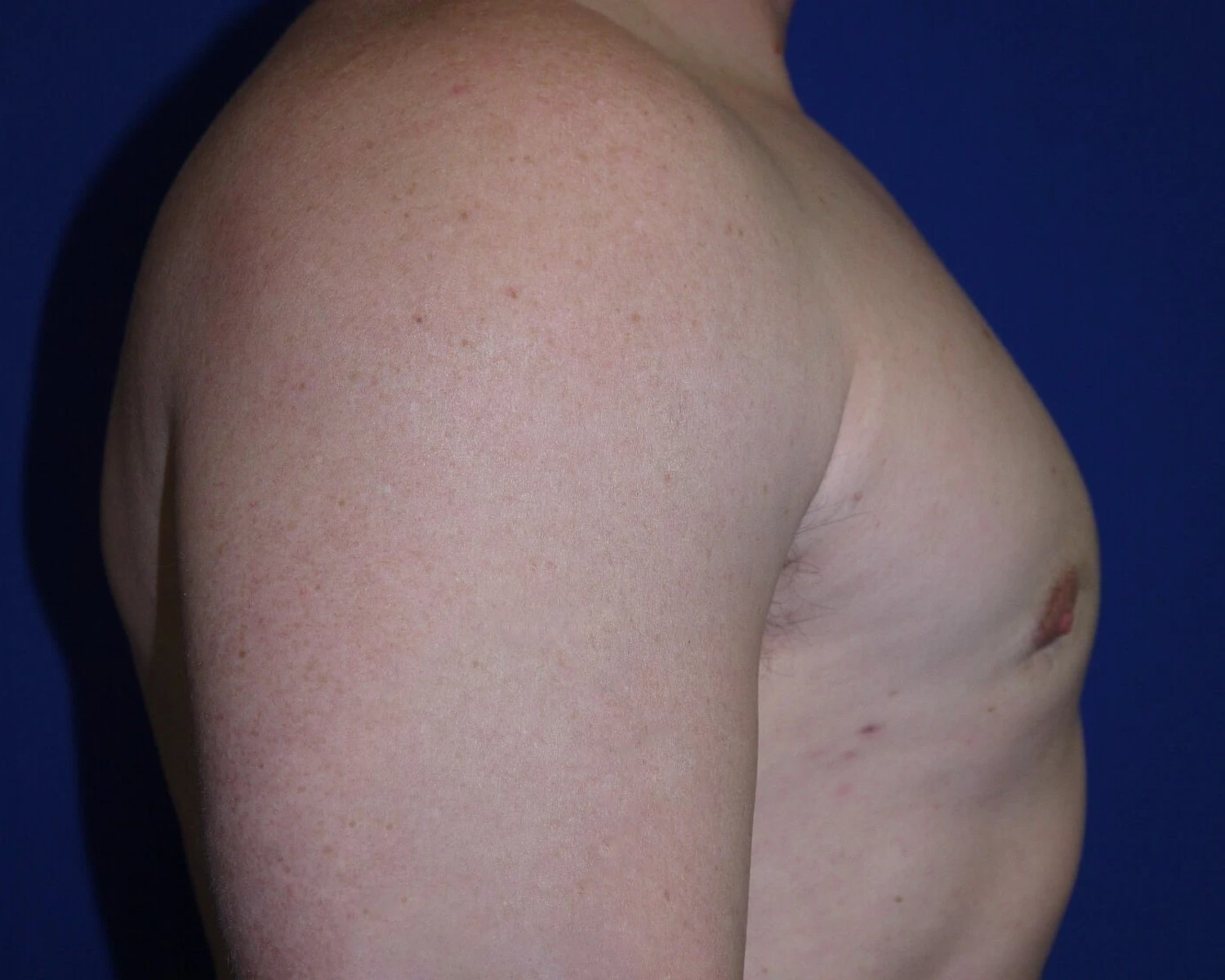 One-Stitch Gynecomastia — Oblique Right view, after