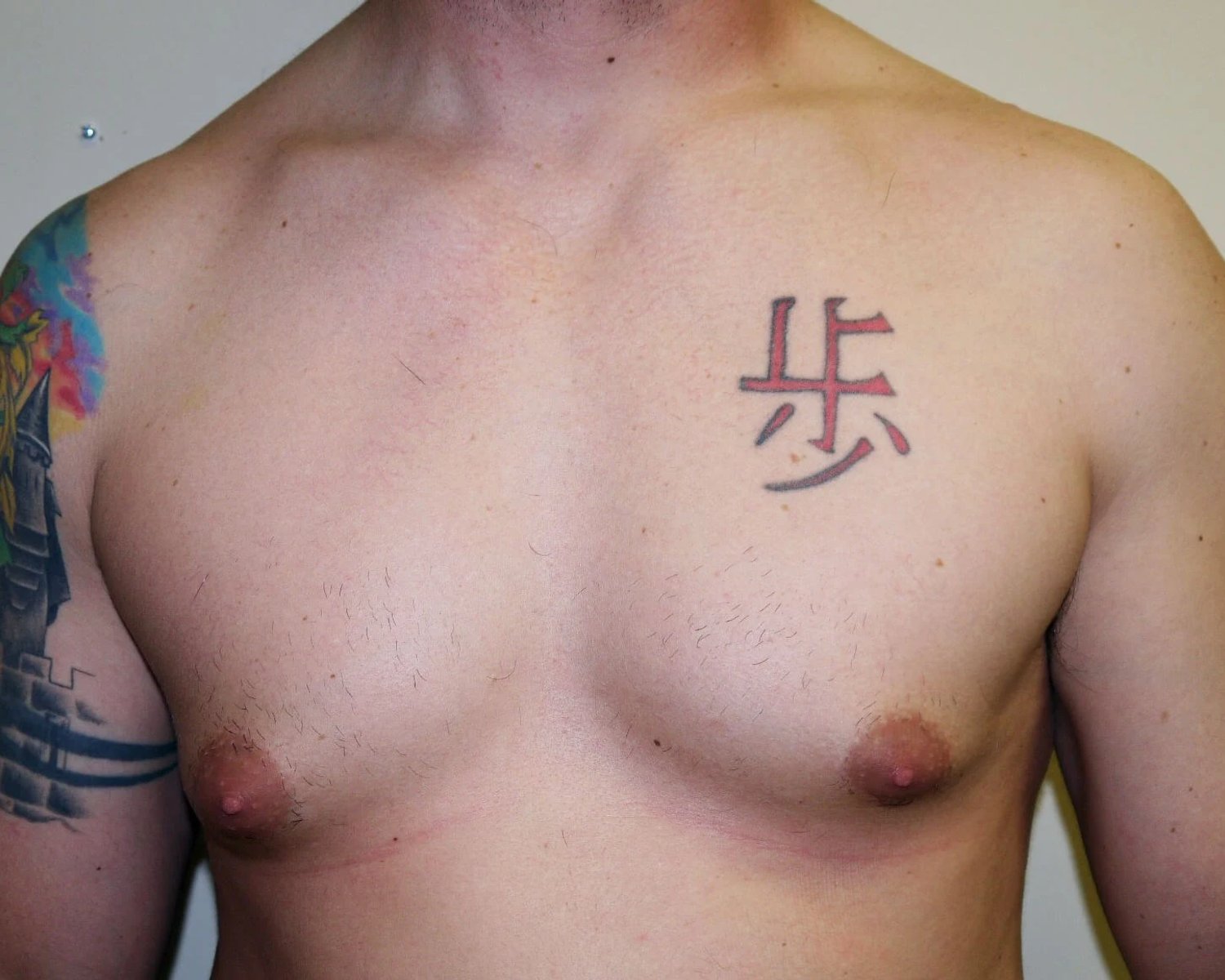 One-Stitch Gynecomastia before