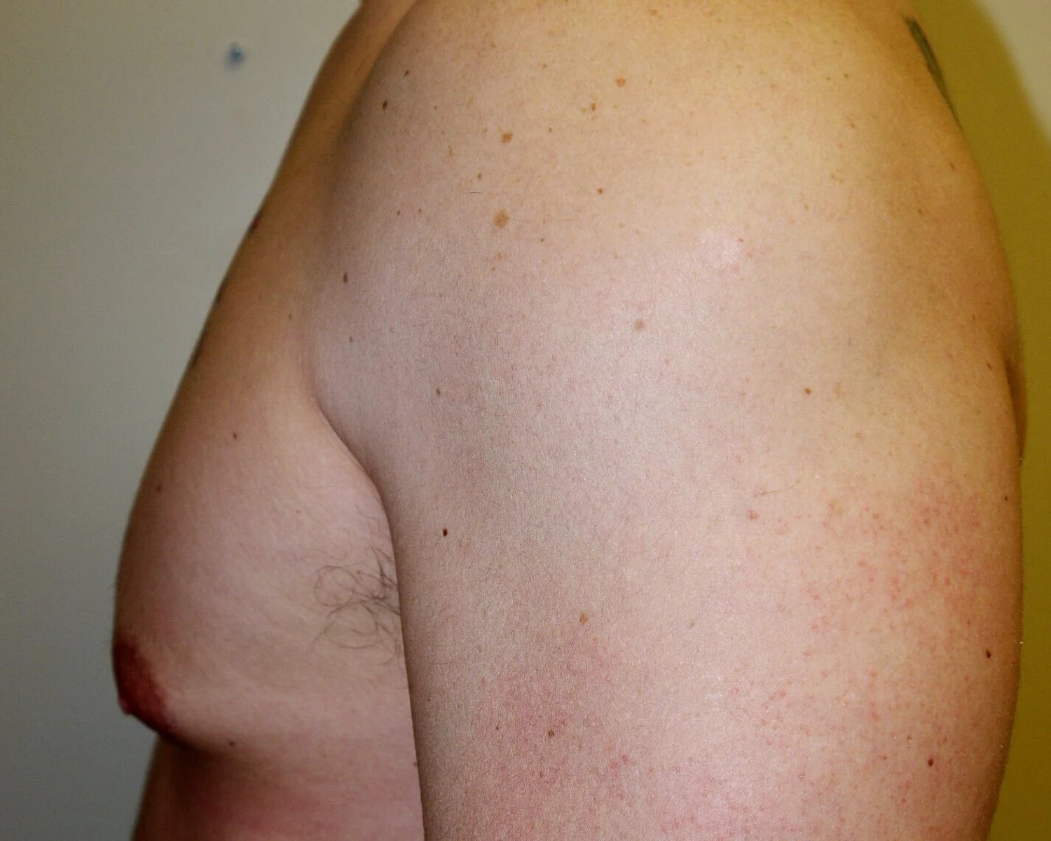 One-Stitch Gynecomastia — Oblique Left view, before