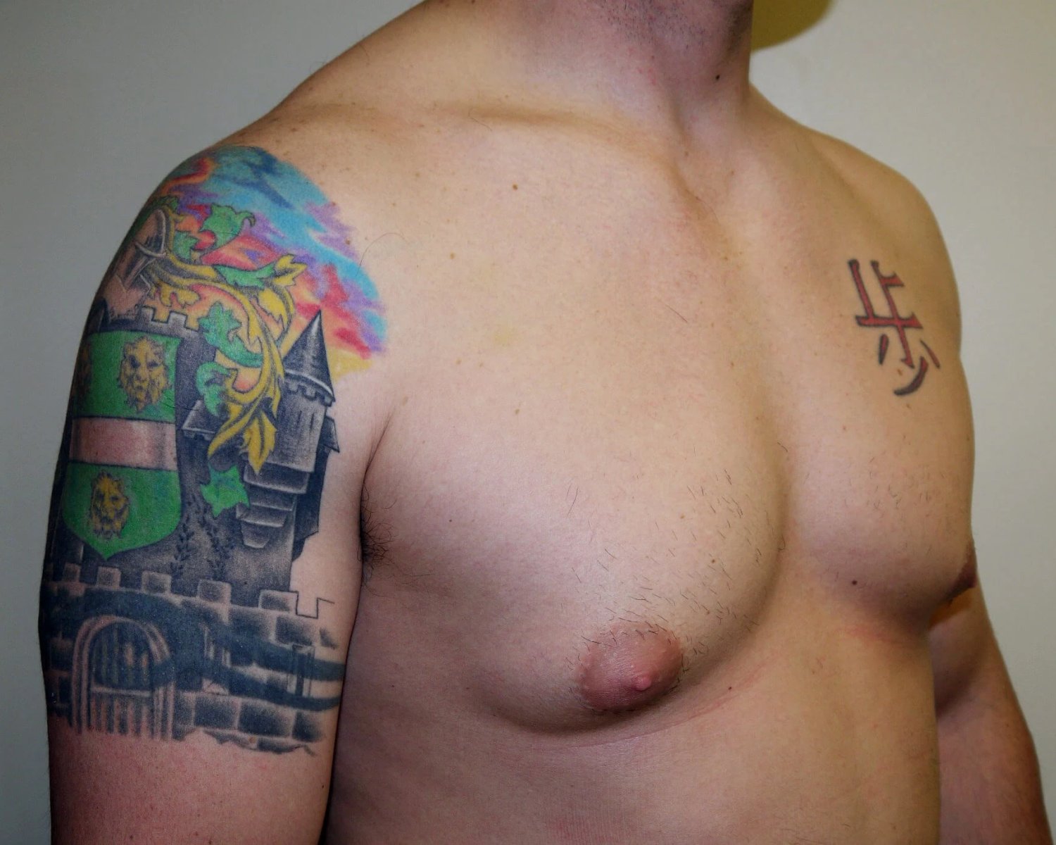 One-Stitch Gynecomastia — Oblique Right view, before