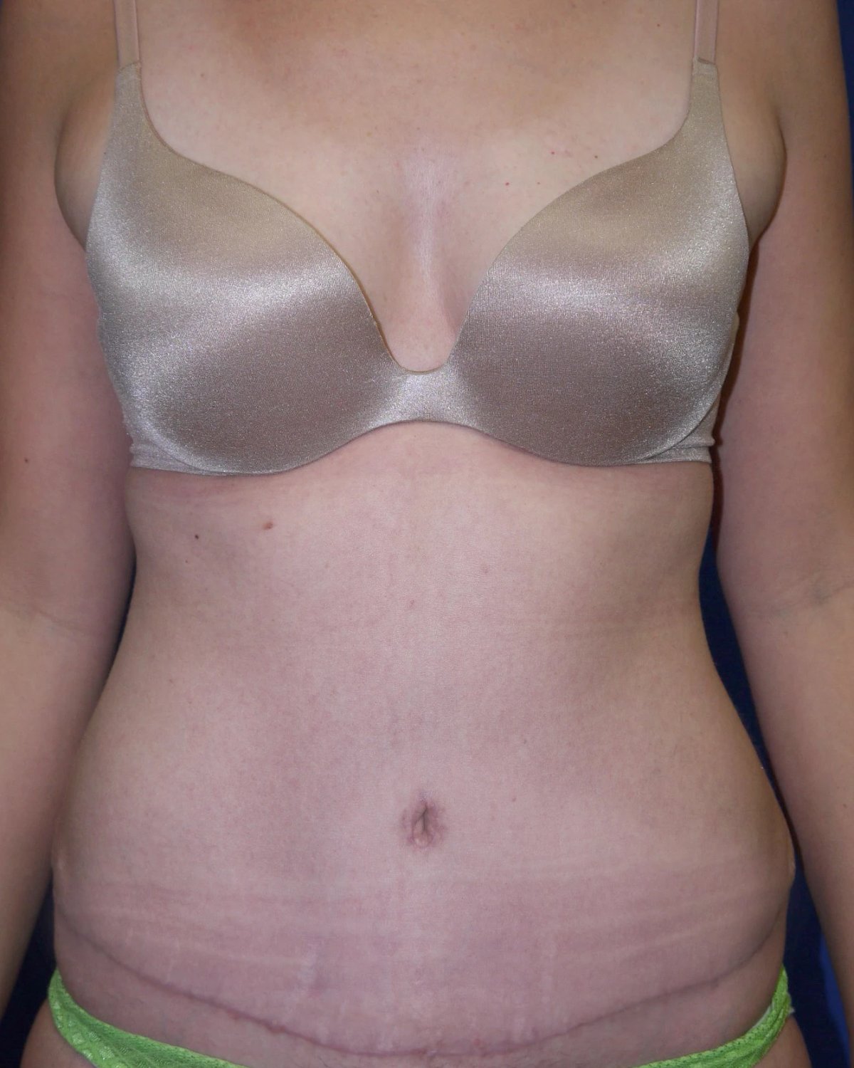 Tummy Tuck after